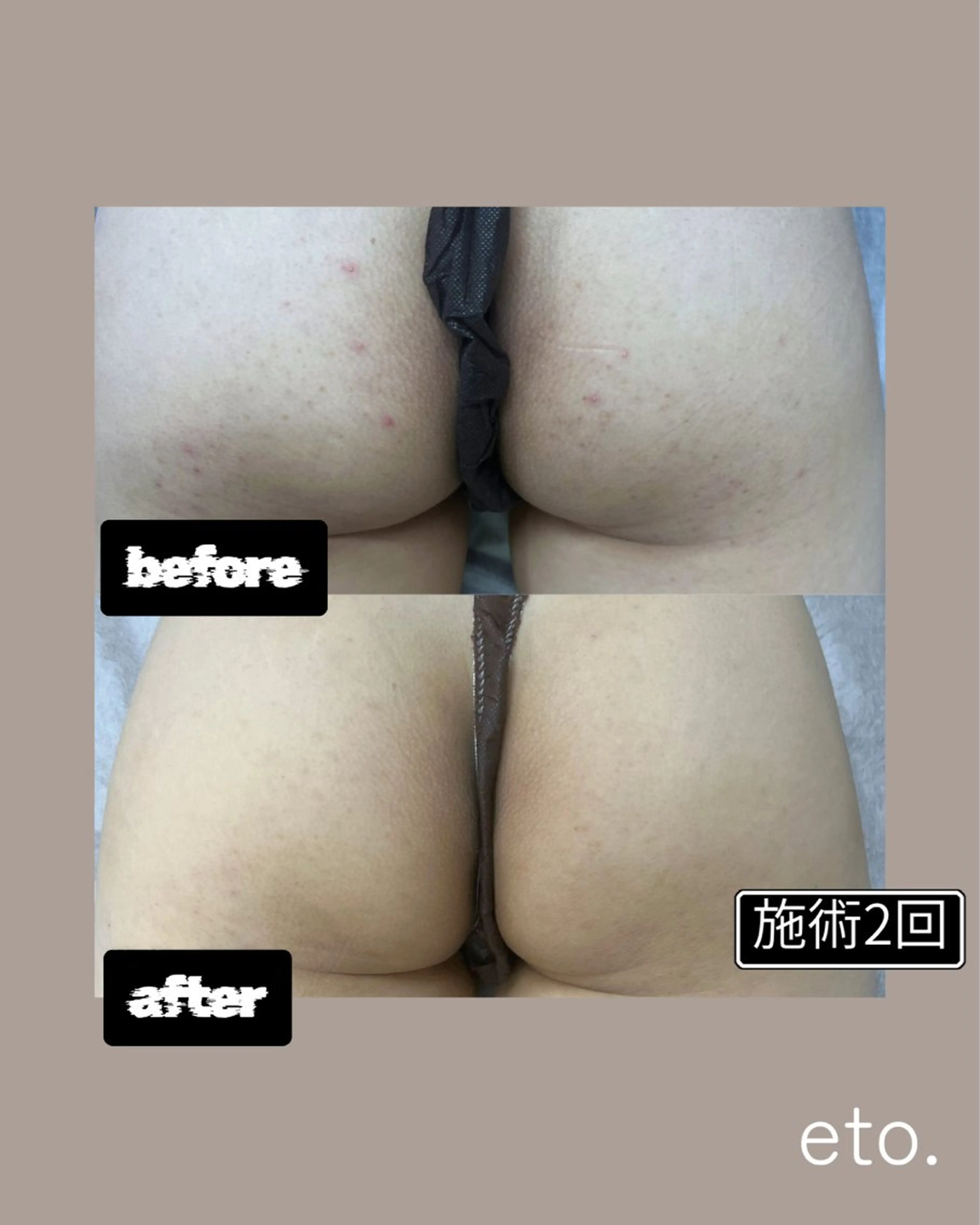 【⚠️モニター様限定】1回あたり7,000円‼️剥離ありor剥離なしハーブピーリング2回🌿の写真