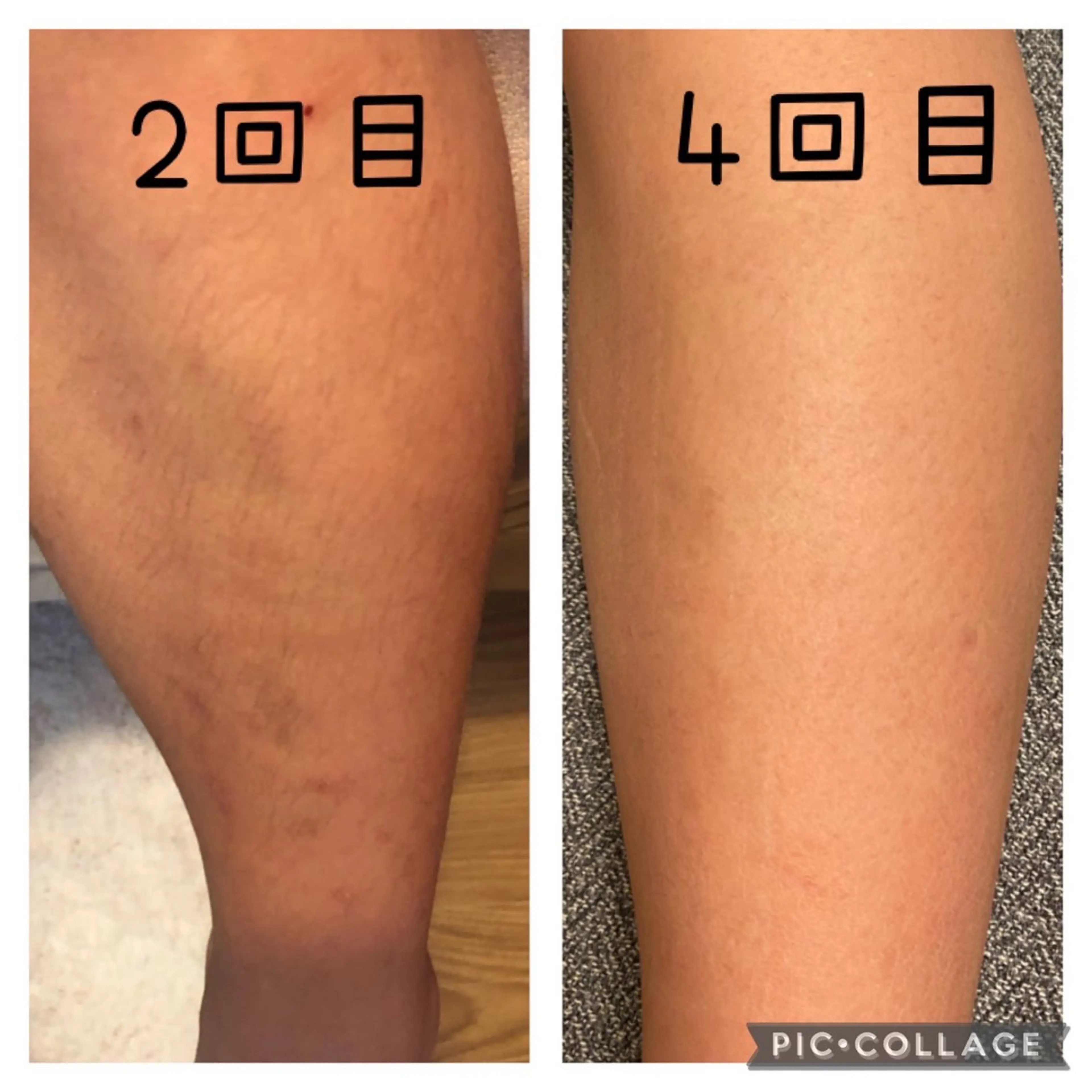 全身脱毛（VIOあり）の写真