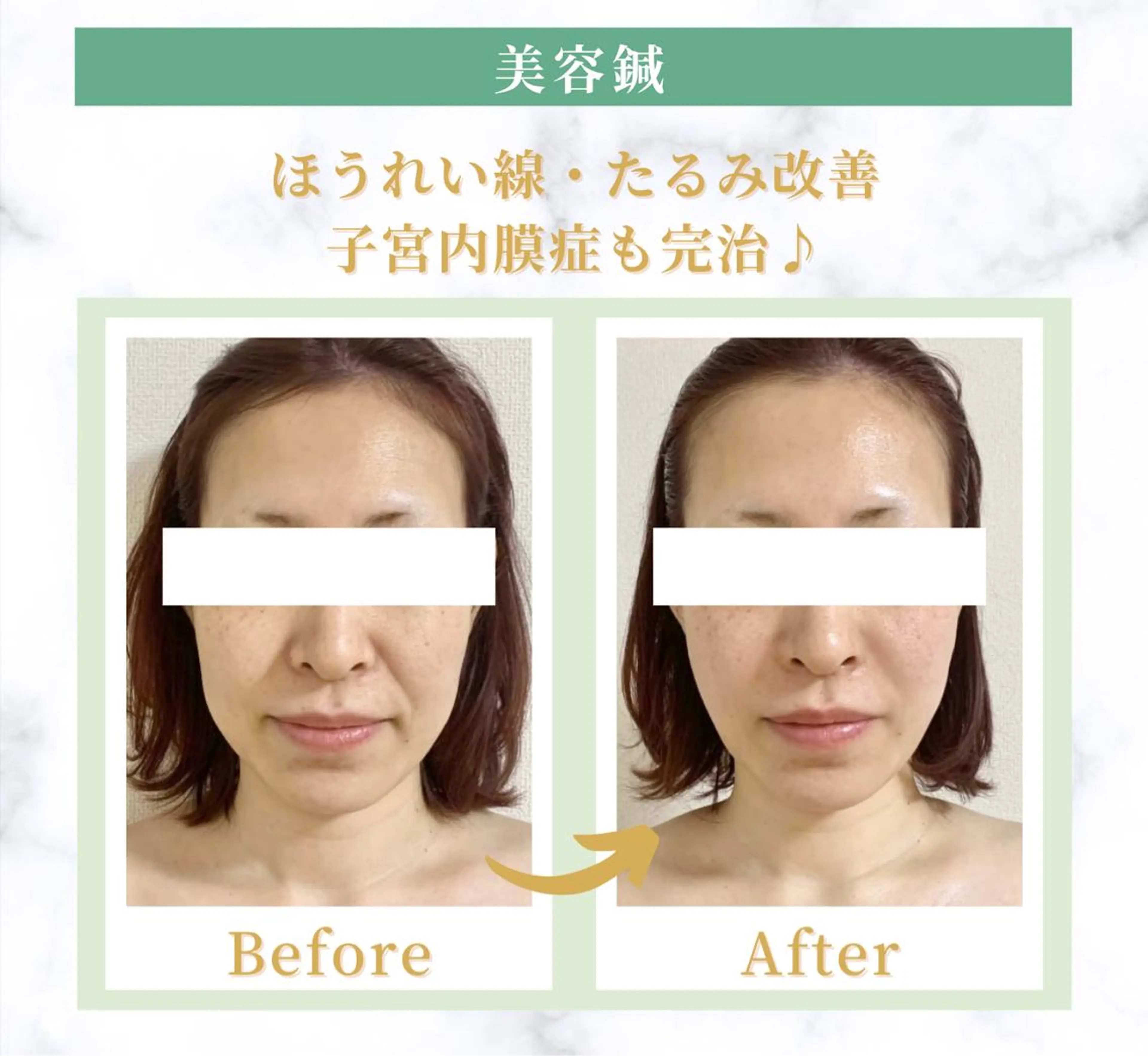 【ベーシック美容鍼】小顔効果抜群❣️しみシワ・たるみ・肌トラブルまで全部改善♪♪表情筋にアプローチする事で顔が上がる⤴️の写真