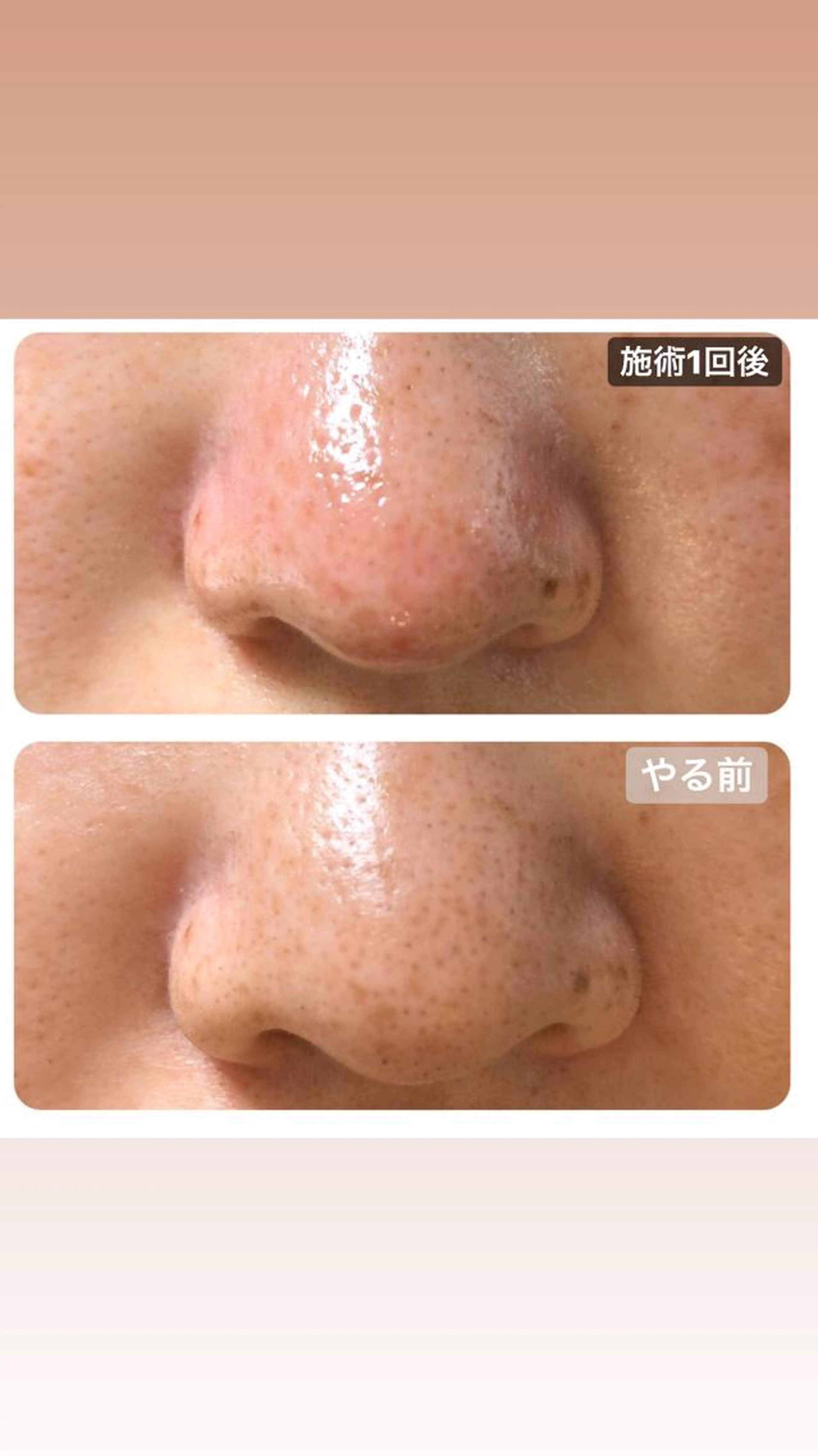 エステ 【エクストラクション毛穴洗浄エステ】の写真