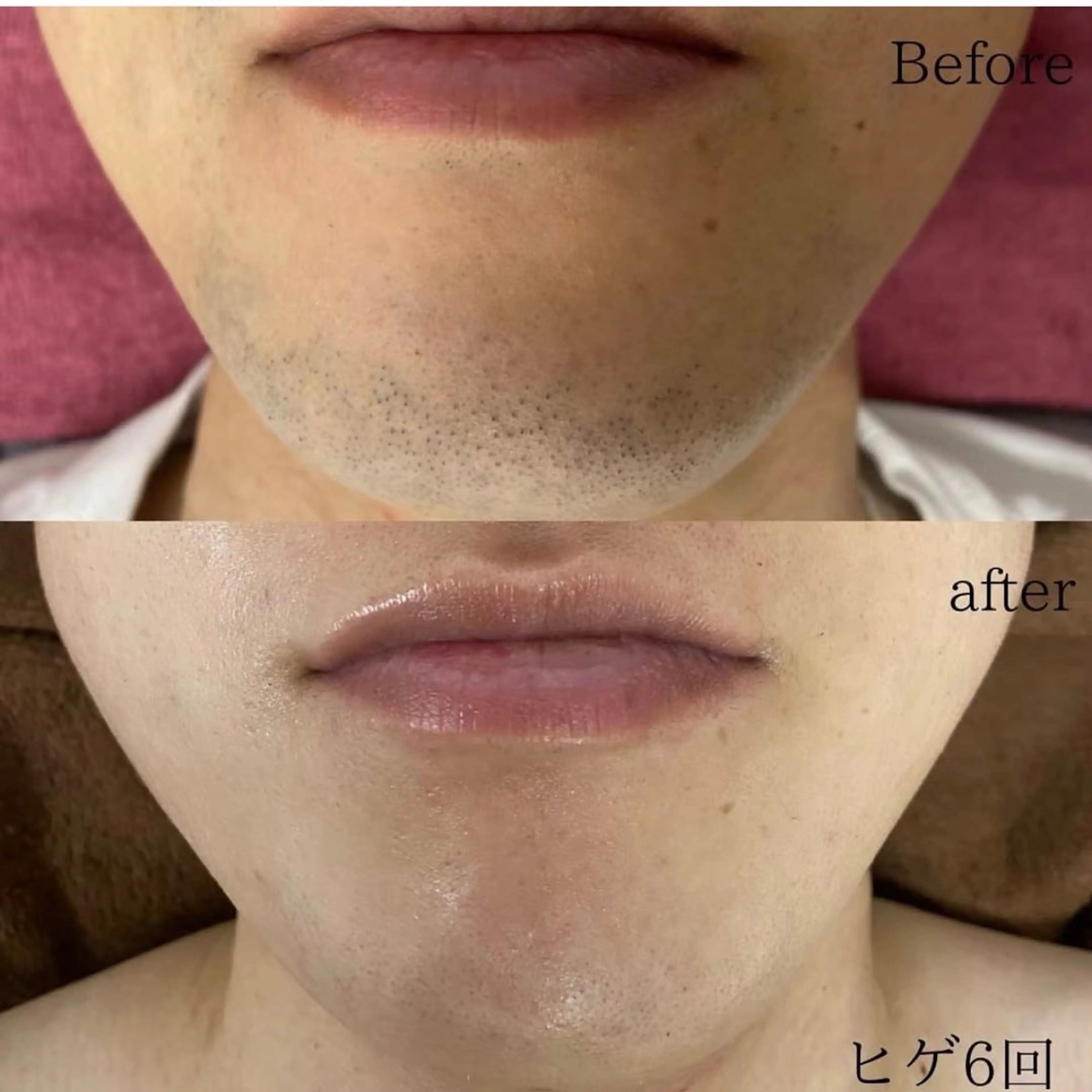 【リニューアルオープン価格】　🗣️通常価格4,400 ⭐️男性ヒゲ脱毛（鼻下、口下、あご、顎下、首）の写真