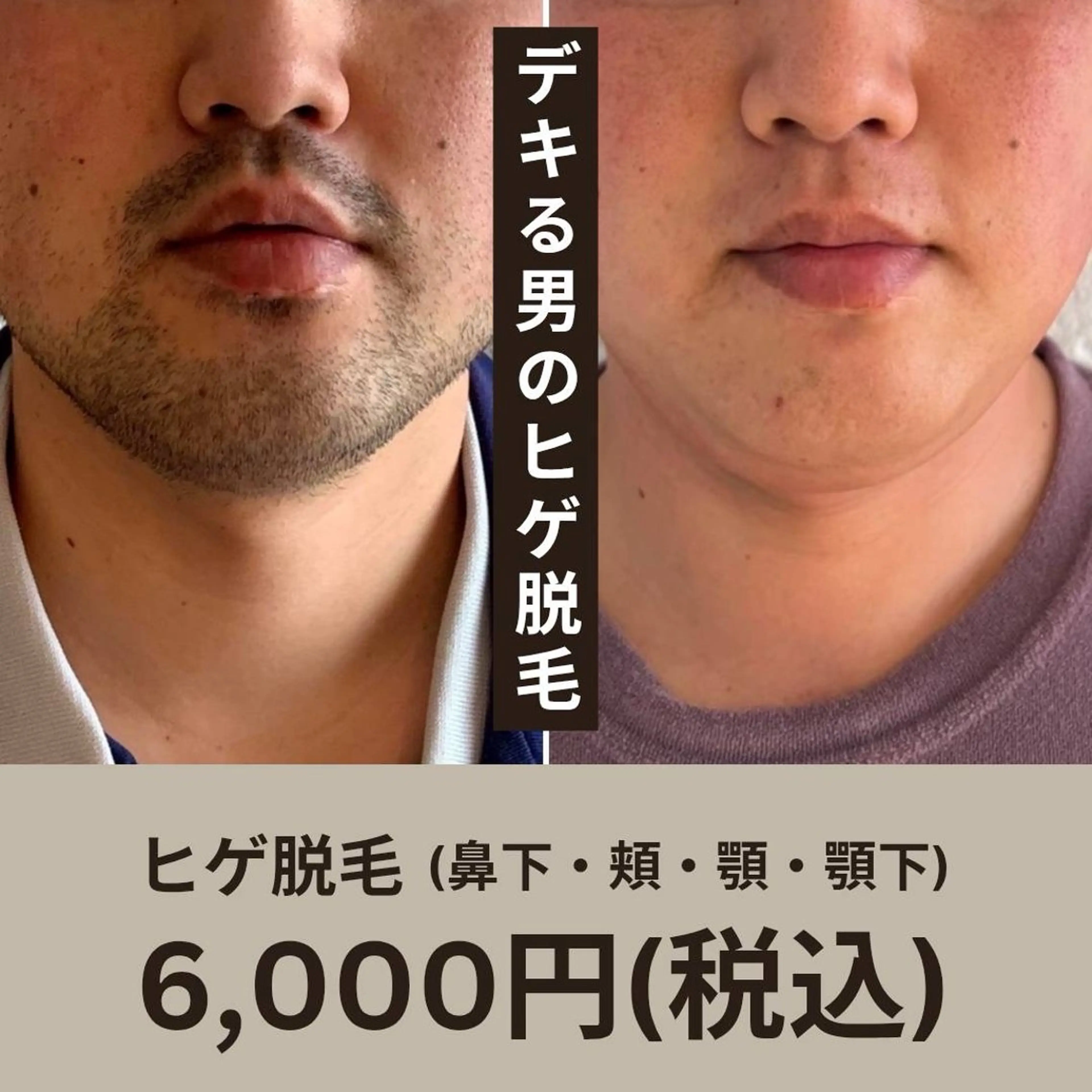 大人気ヒゲ脱毛の写真