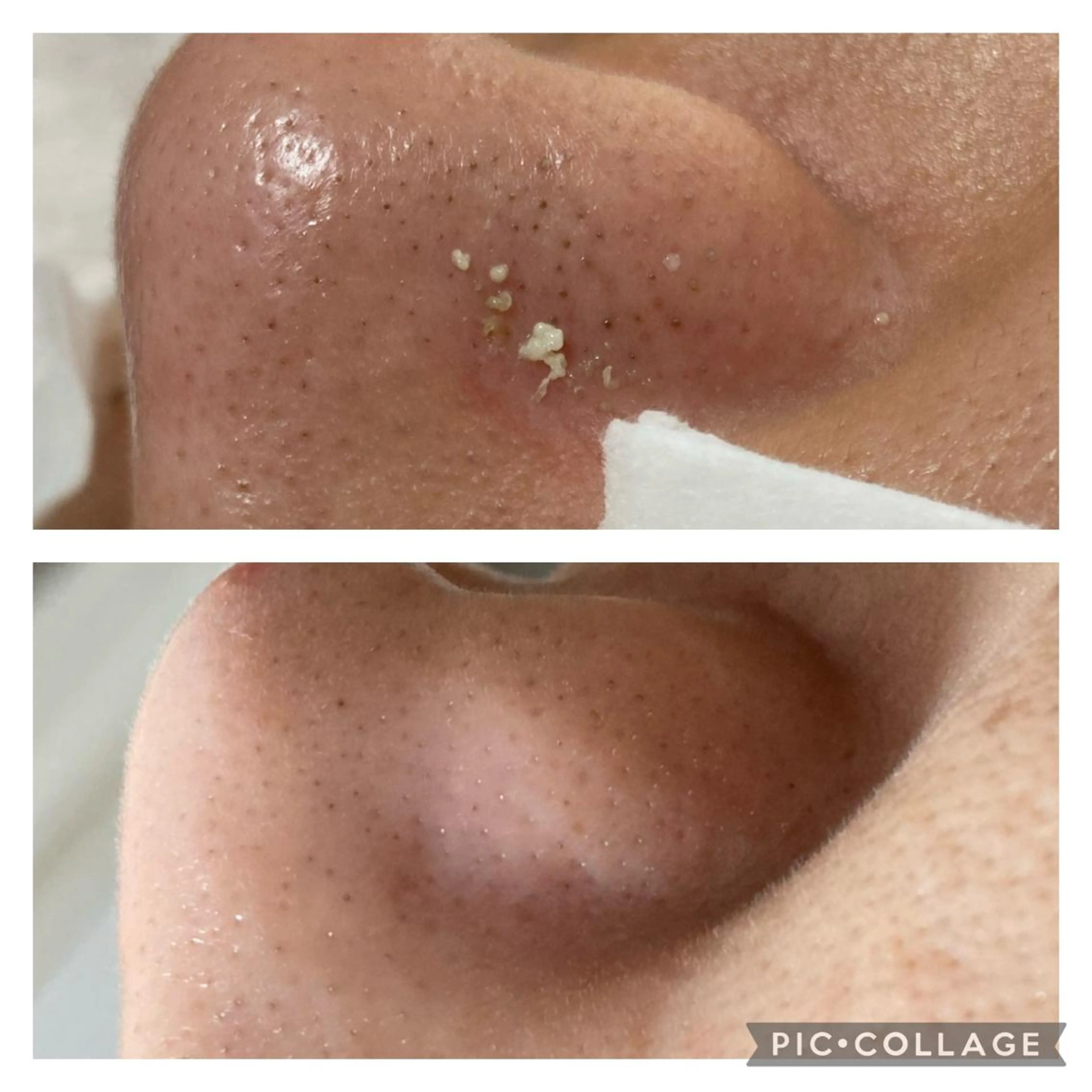 毛穴詰まり・ザラつき改善ショートコース⚡️の写真