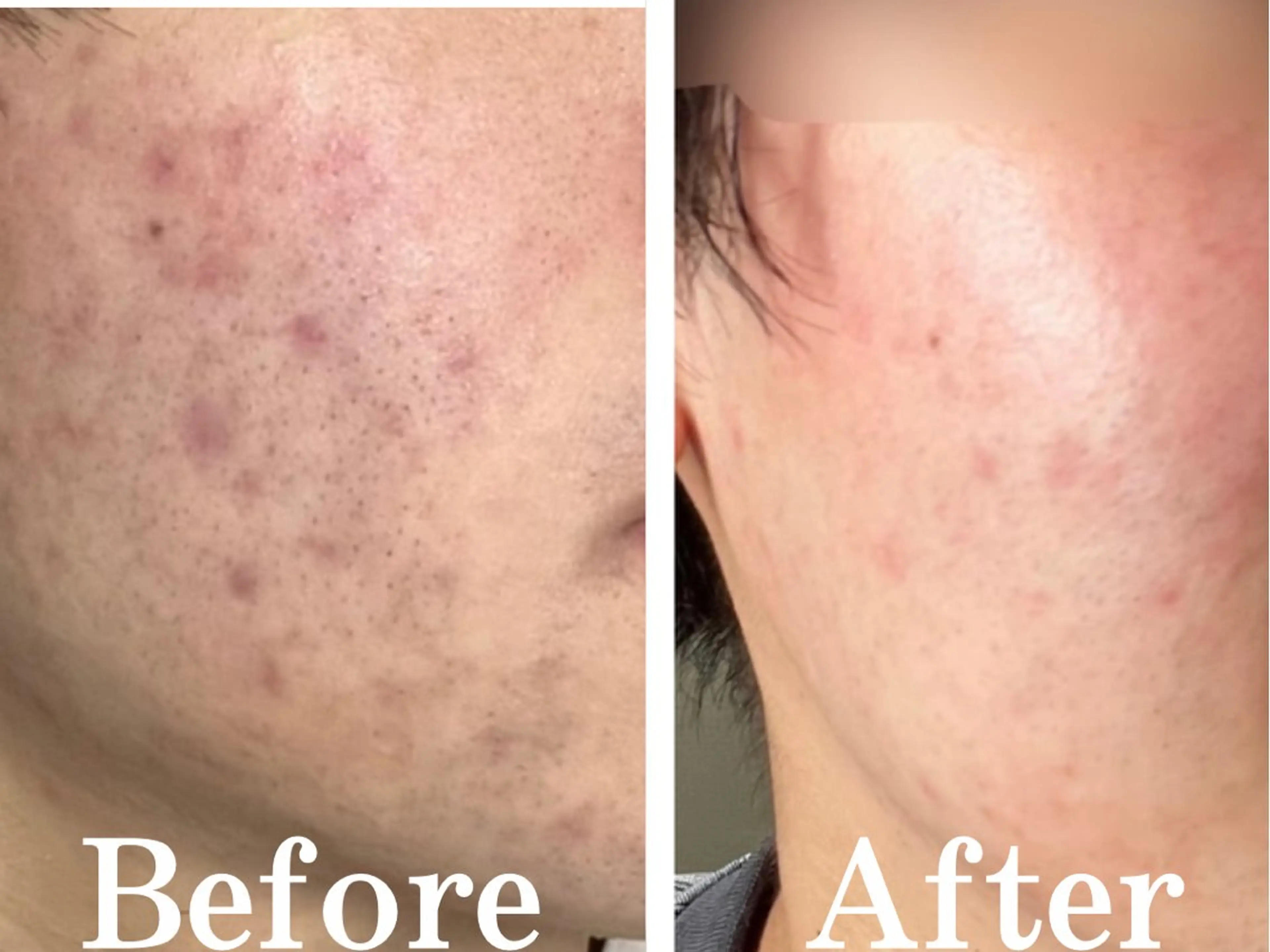 エステ アイスリーサロン所属・毛穴改善サロン アイスリーのエステ・リラクイメージ