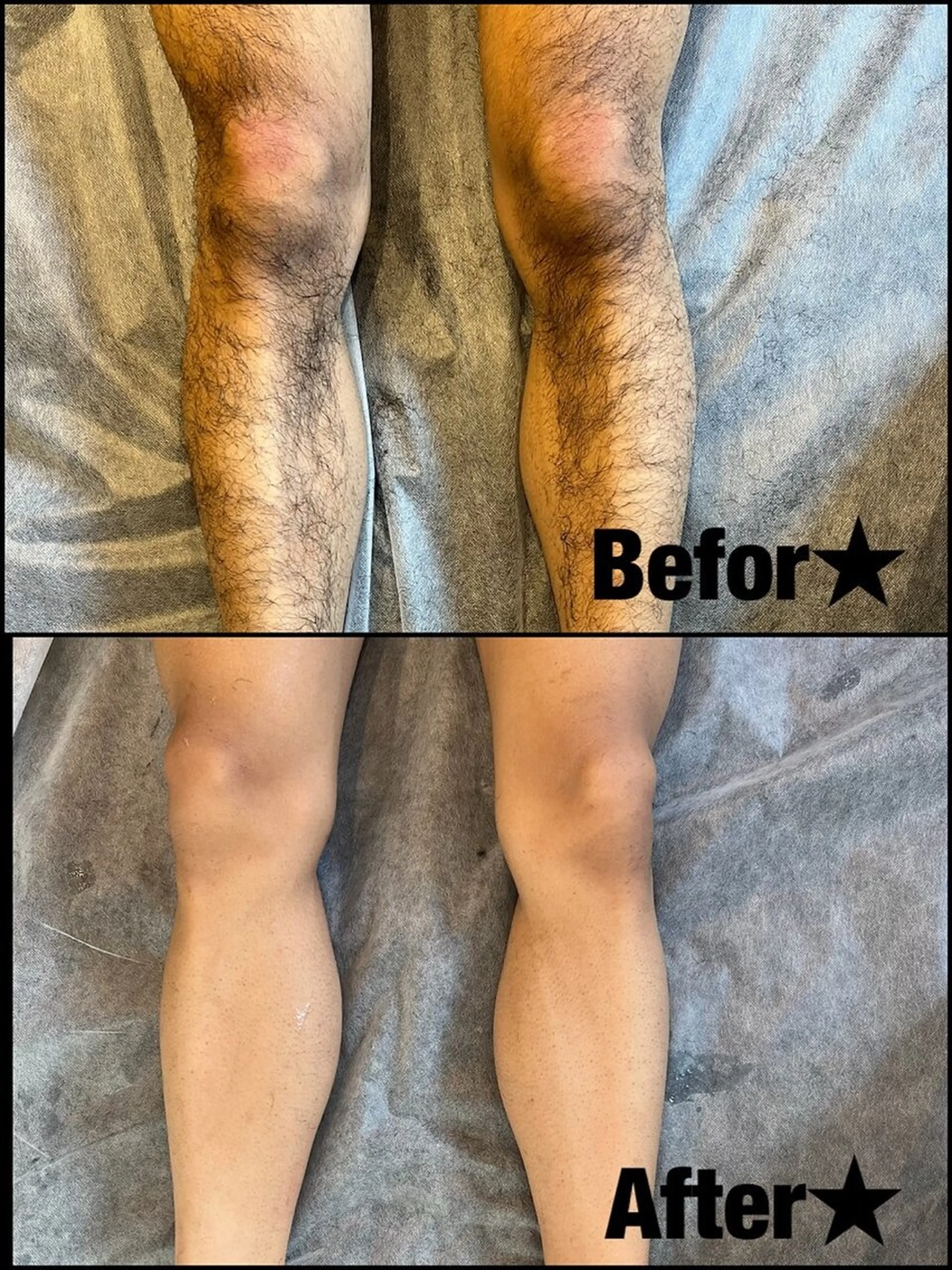 足全体脱毛の写真