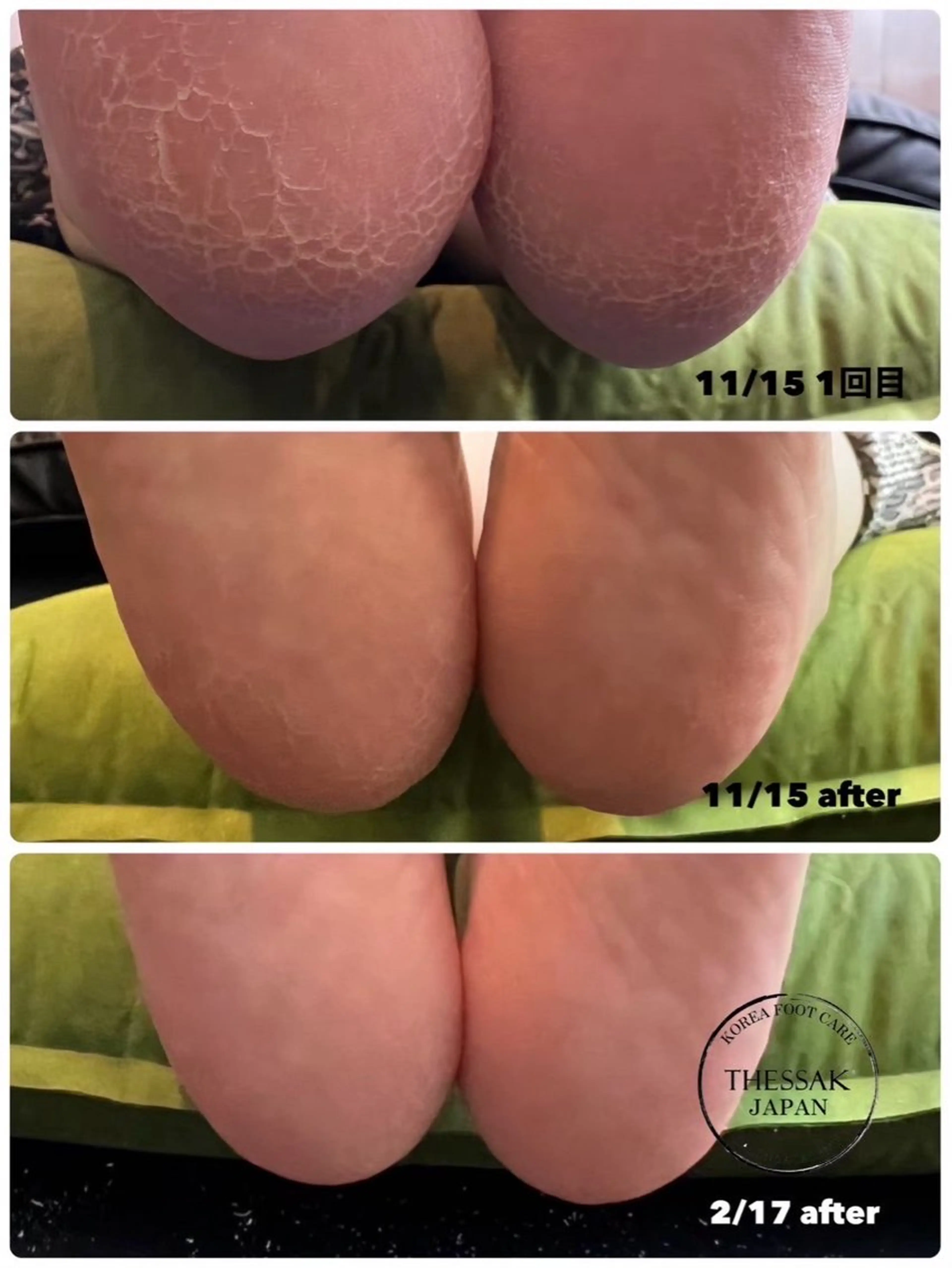 メンズ ネイル メンズ韓国風 フットネイル 韓国ネイル エステ リラク 韓国式足裏角質ケア&脱毛サロンRomeo所属・韓国式足裏角質ケア& 脱毛サロンRomeoのエステ・リラクイメージ