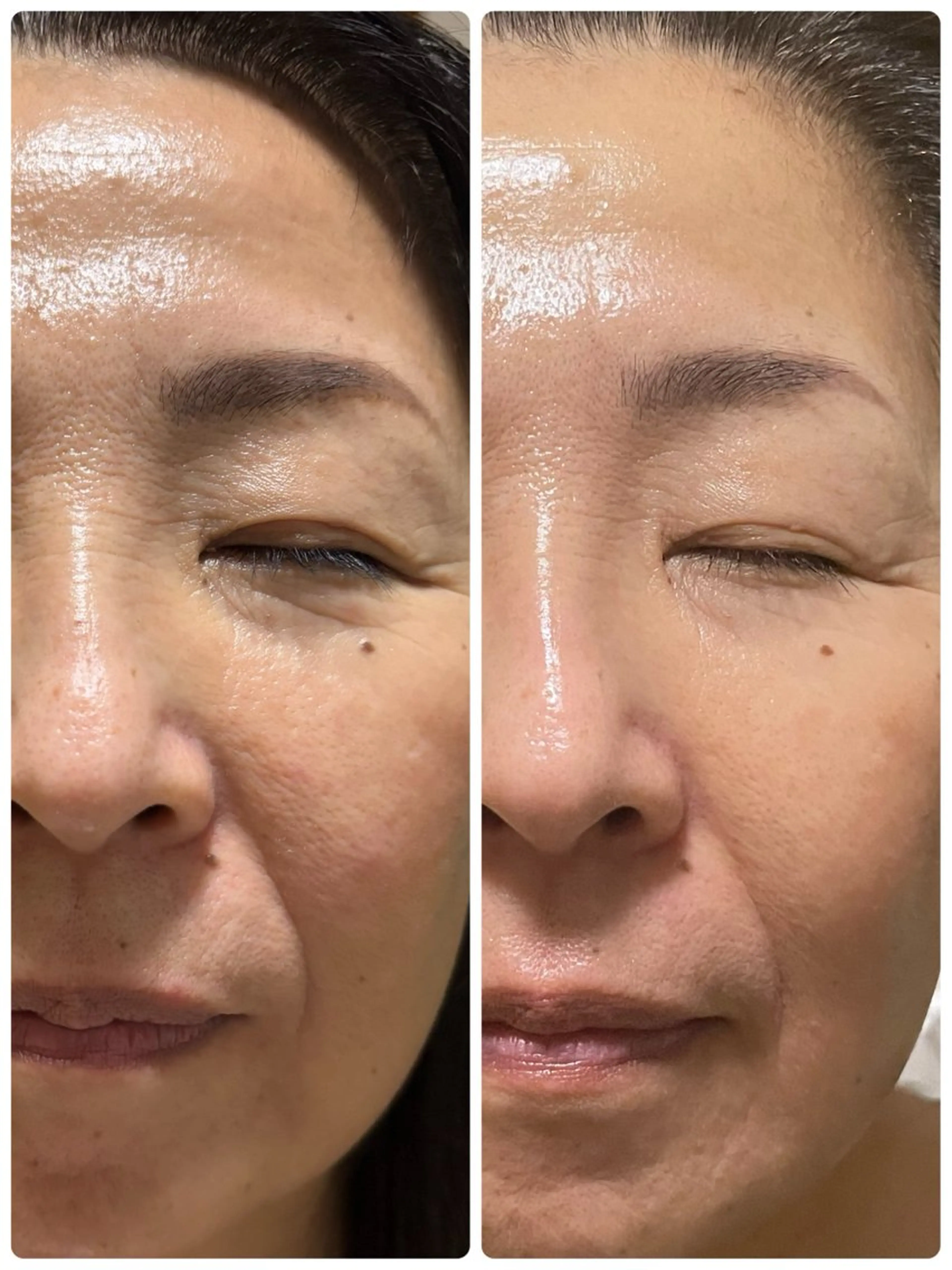 艶肌コース　韓国式肌管理ララピール　50分　専用ウォッシング・専用ピール２種・専用ゲルパックの写真