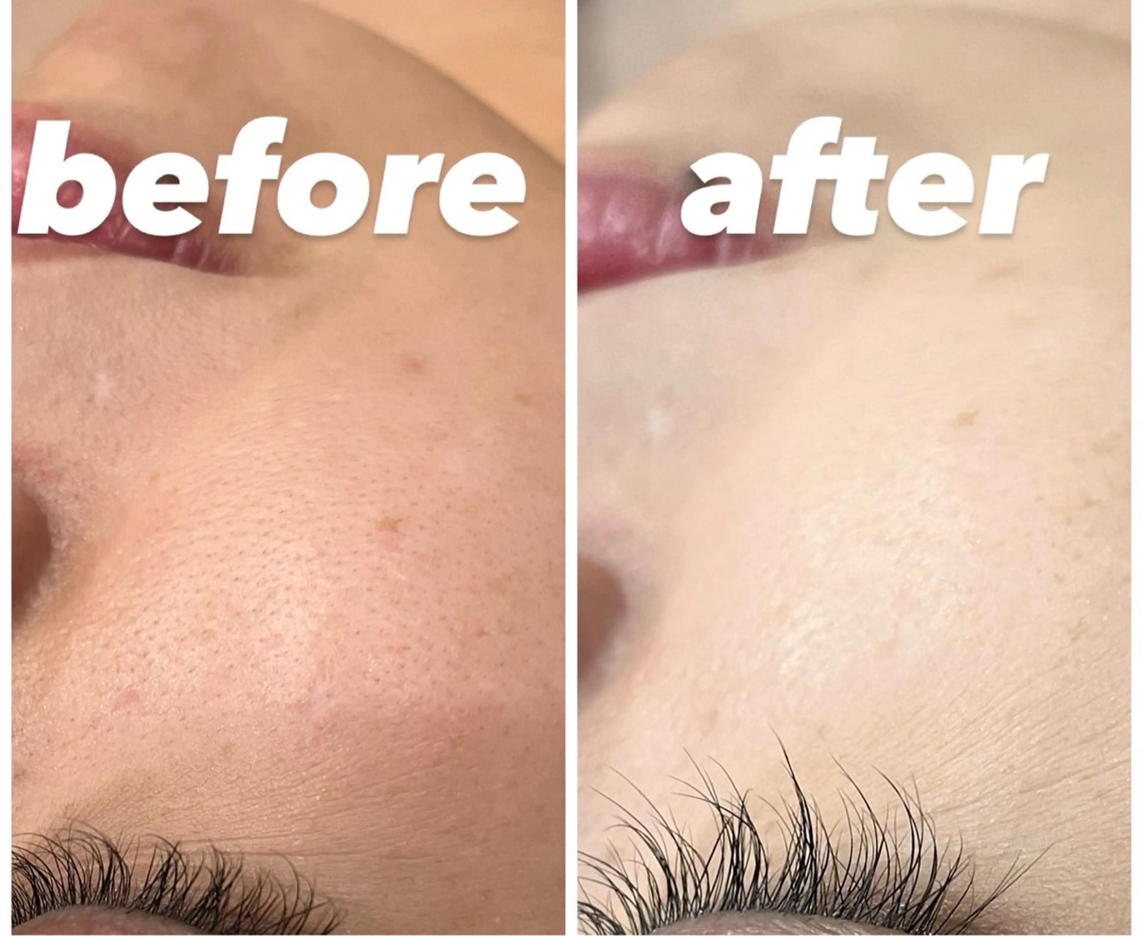 美白✨コラーゲン顔脱毛お試し60%オフ　3,300円の写真