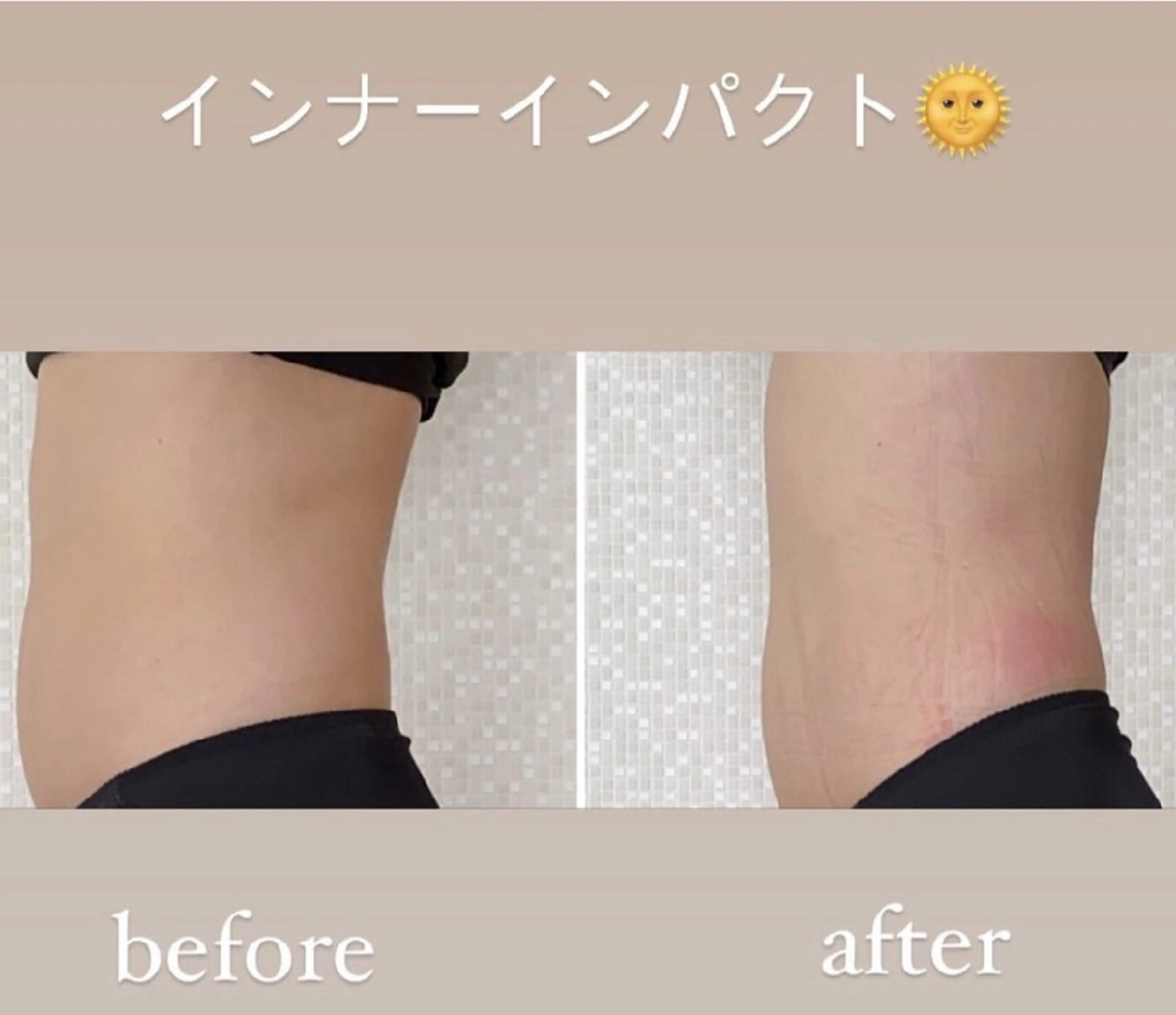 インナーインパクト　1回コース×2】皮下7cm程度まで届く！！の写真