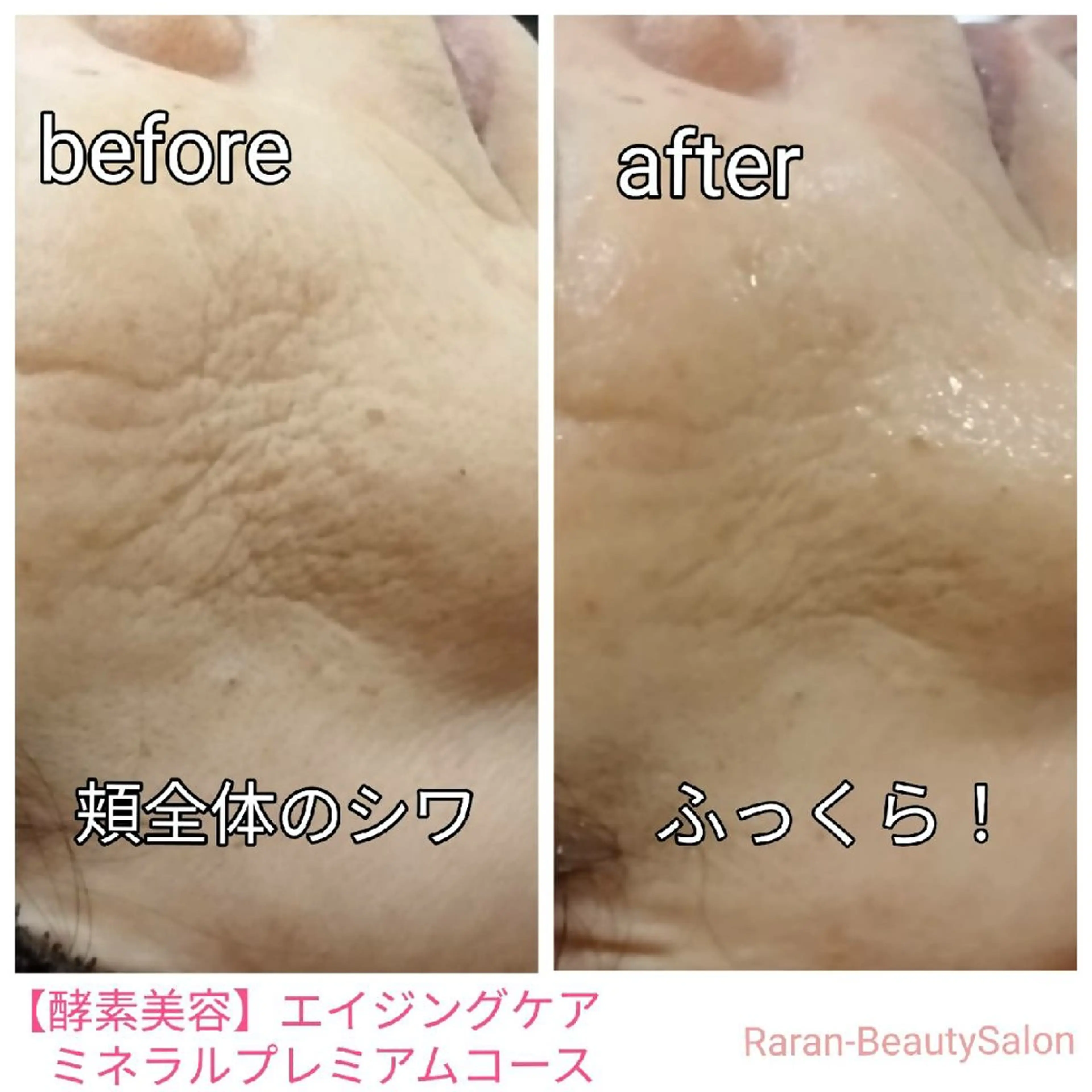 最強スペシャルエステ誕生♥️【ミネラル酵素美容* エイジングケアコース】 ハリ✨艶✨くすみ✨の写真