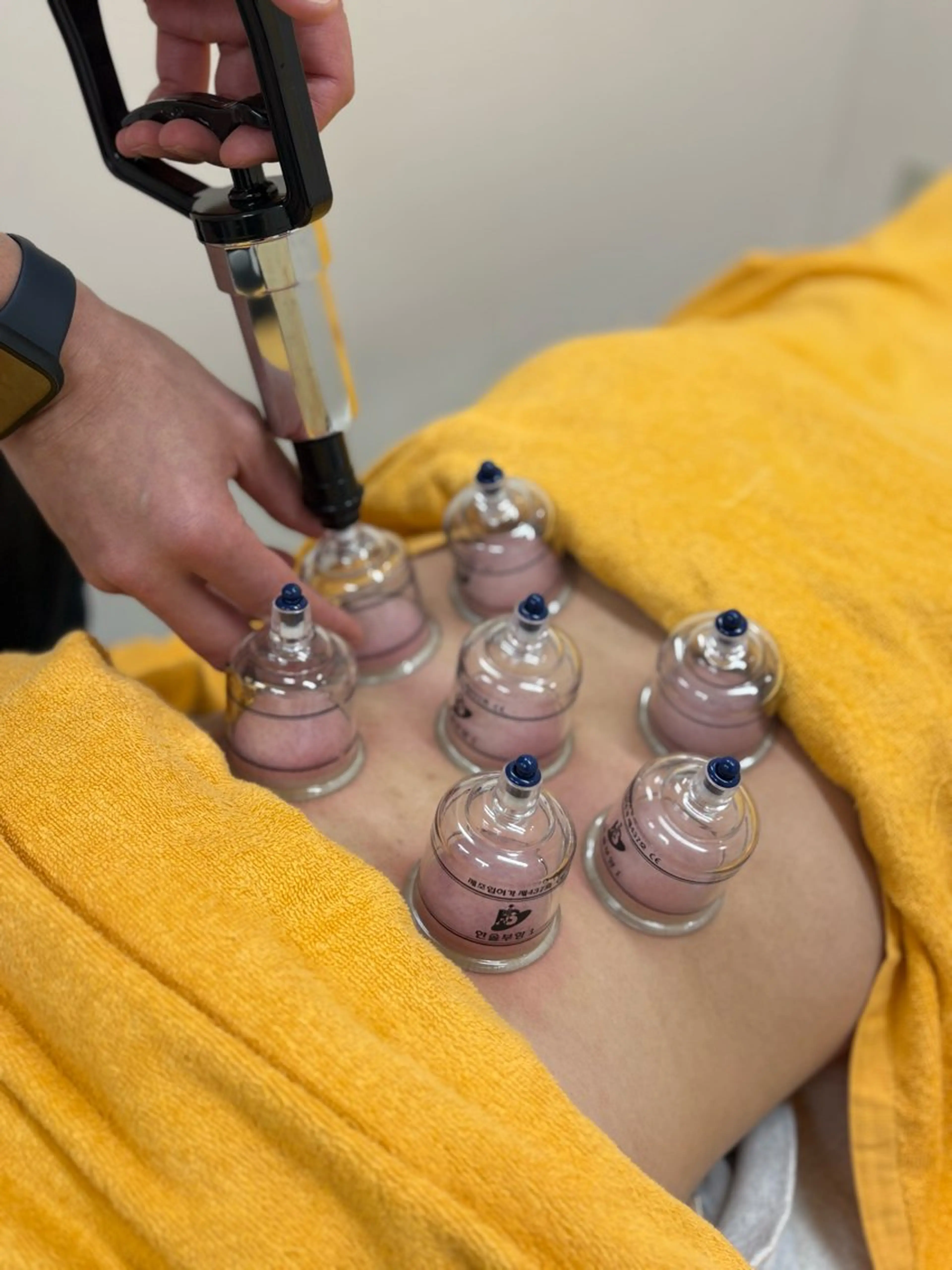 カッピング（吸い玉）の写真