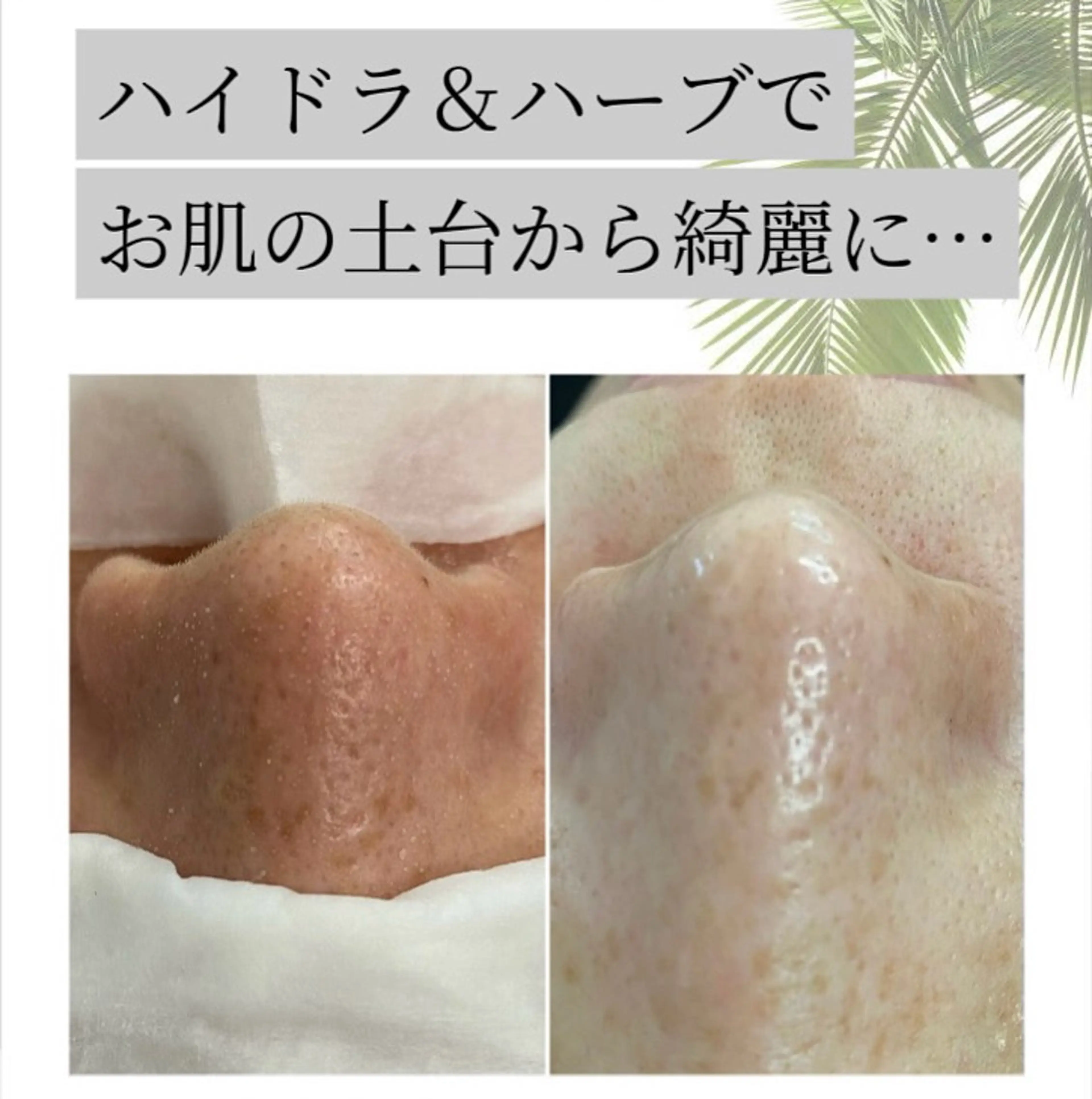 当店No.1人気フェイシャルMENU🌿🫧【肌質改善★ハイドラ✖️ハーブ】土台から綺麗に…✨ミニモ限定特典あり🫶🏾の写真