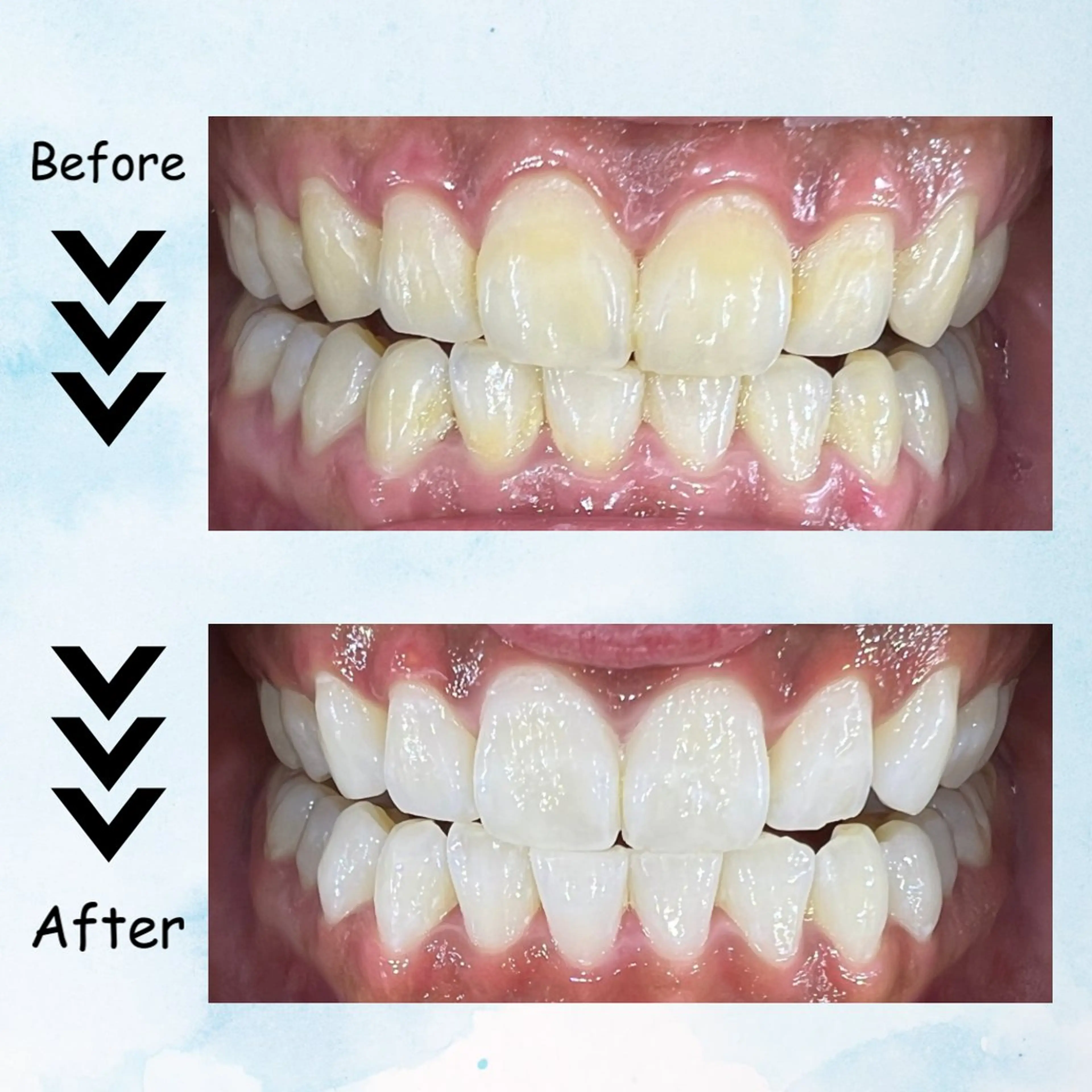 【minimoセール限定】ホワイトニング体験クーポン(9分×2照射) ※オールタイム使用可能の写真