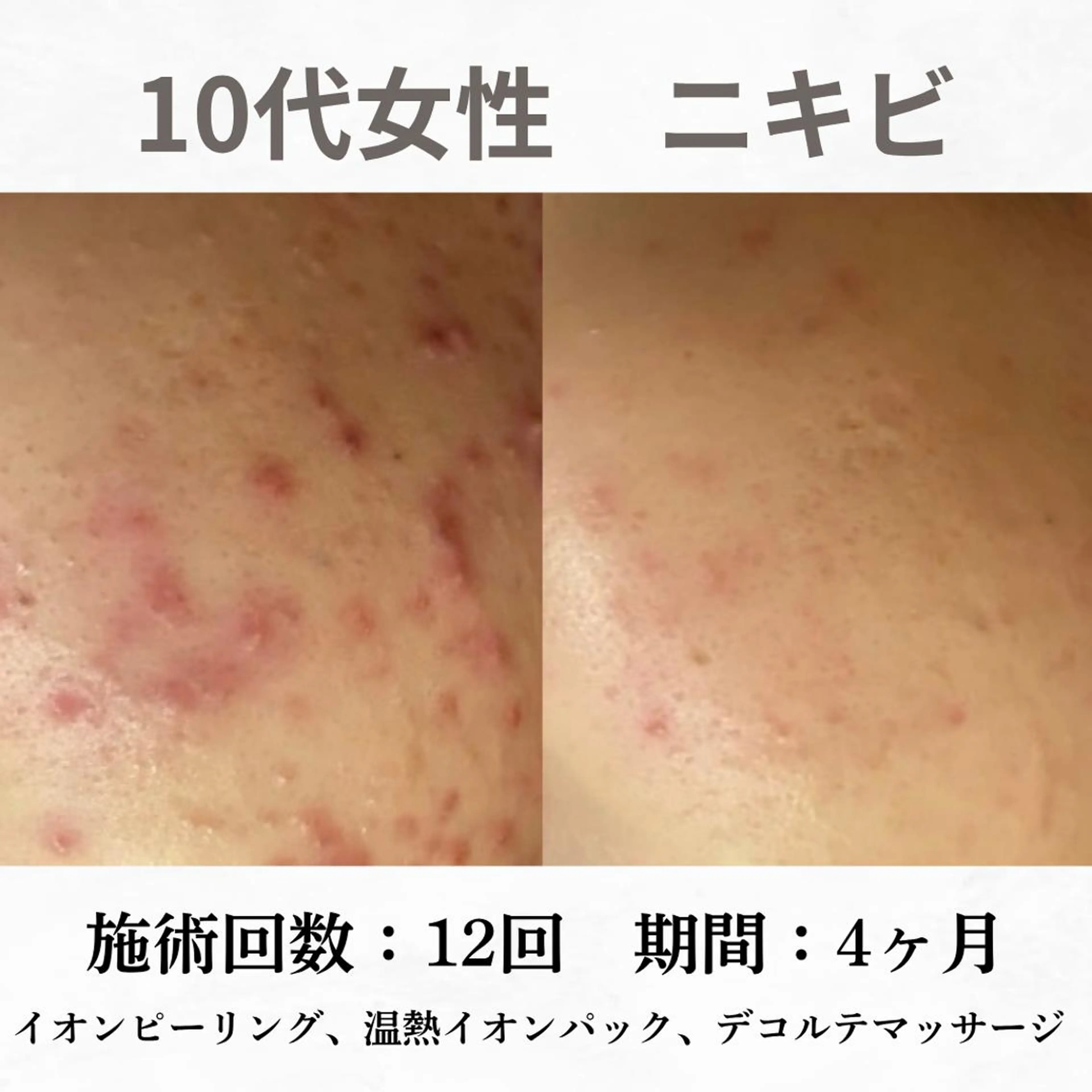 重度ニキビ専門🌷 ダウンタイムなしのエステ・リラクイメージ