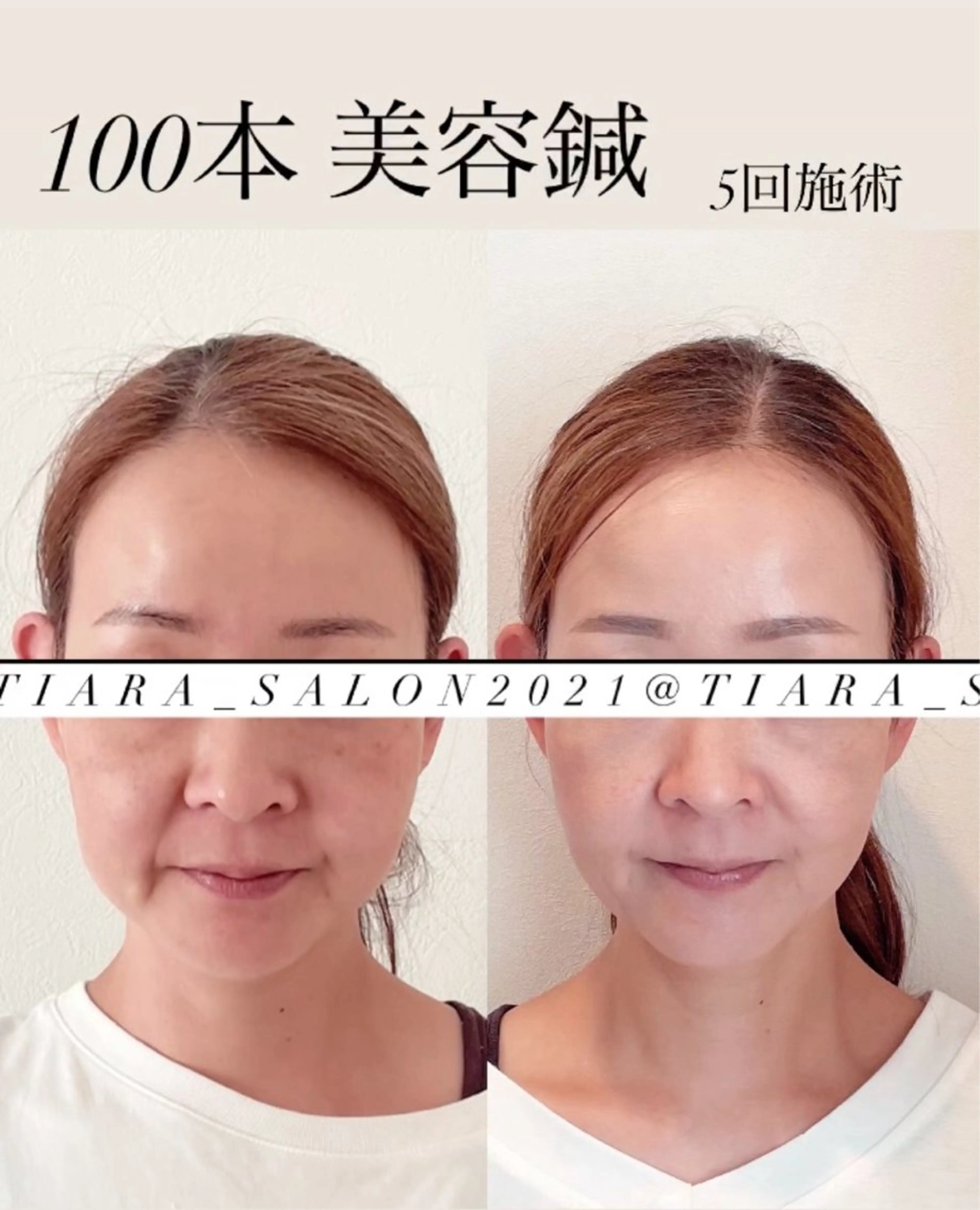 美容鍼灸サロン　TIARA所属・鍼灸サロン TIARA　美容鍼のエステ・リラクイメージ