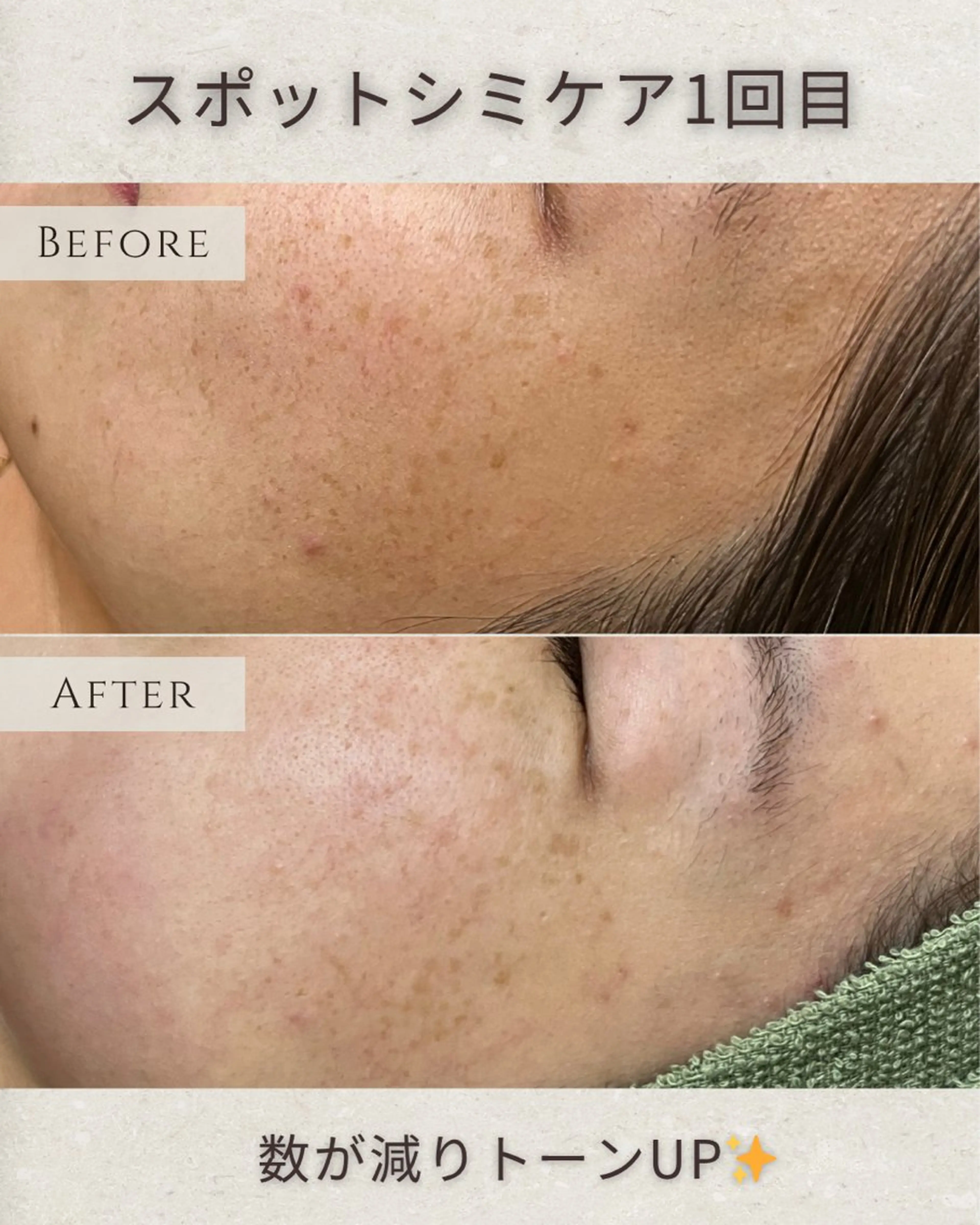 エステ シミ毛穴|眉Wax THE  flowのエステ・リラクイメージ