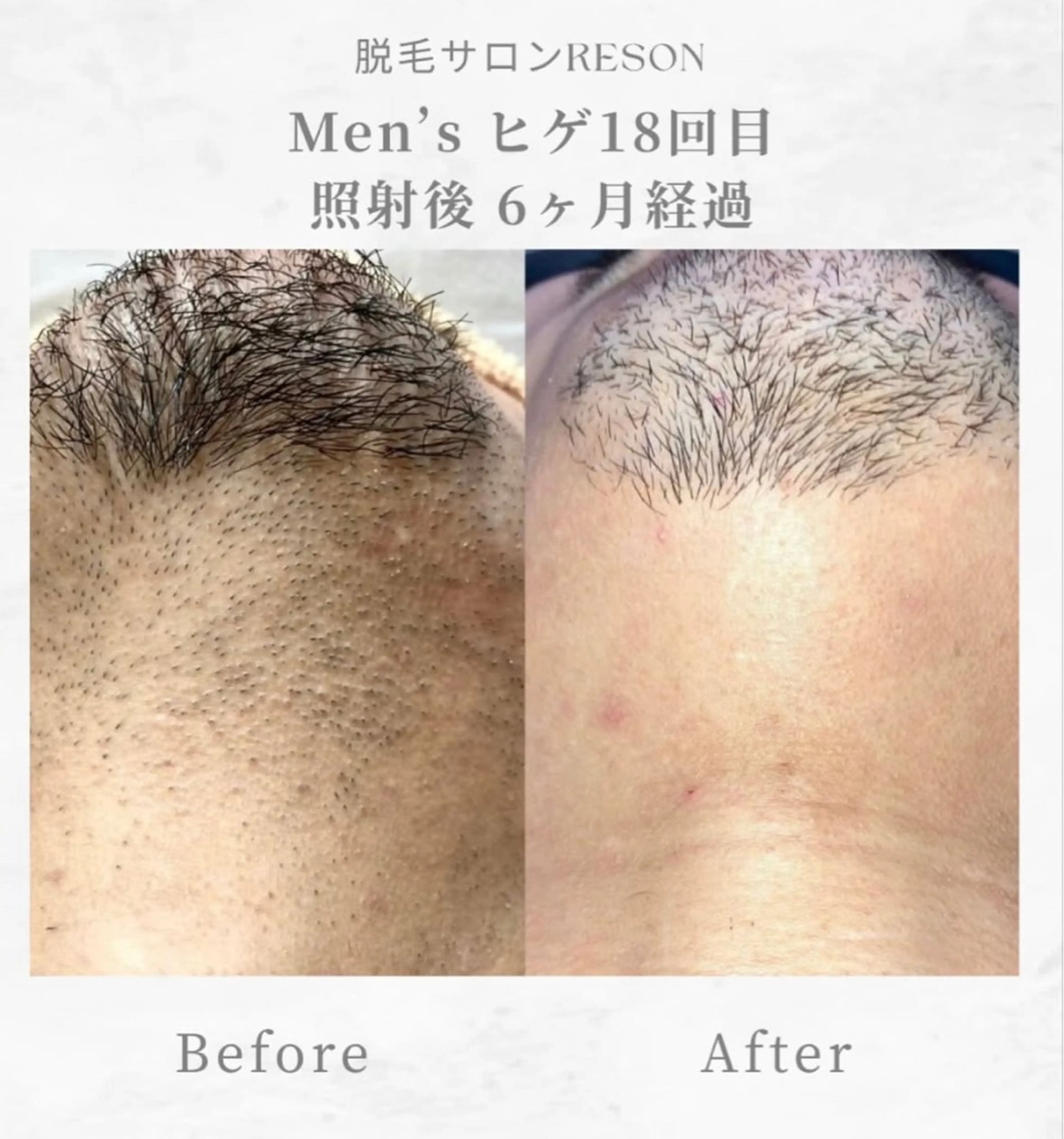 メンズ エステ RESON 調布店所属・都度払いの脱毛サロン RESONのエステ・リラクイメージ