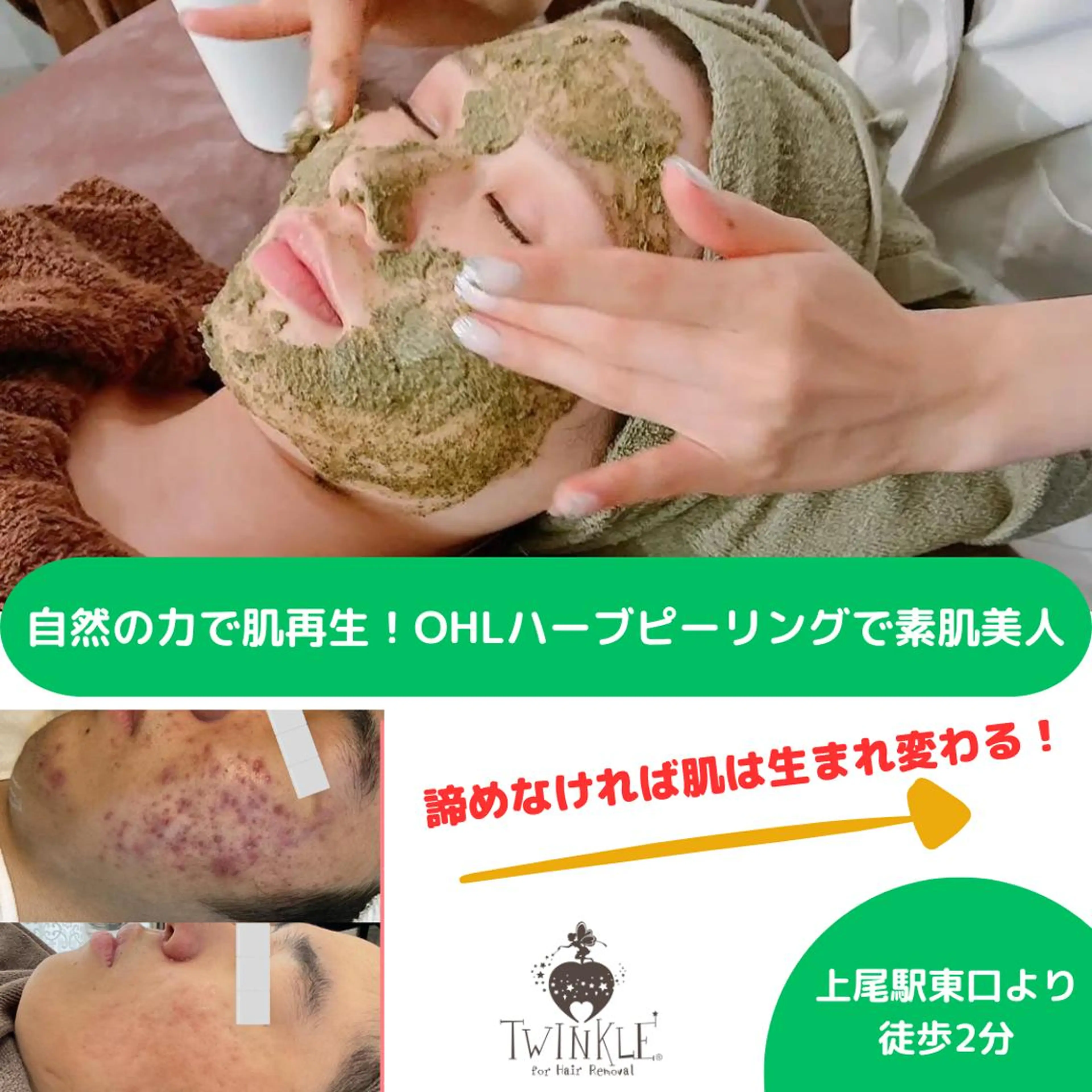 ☆キャンペーン☆剥離なし！ハーブピーリング♪の写真