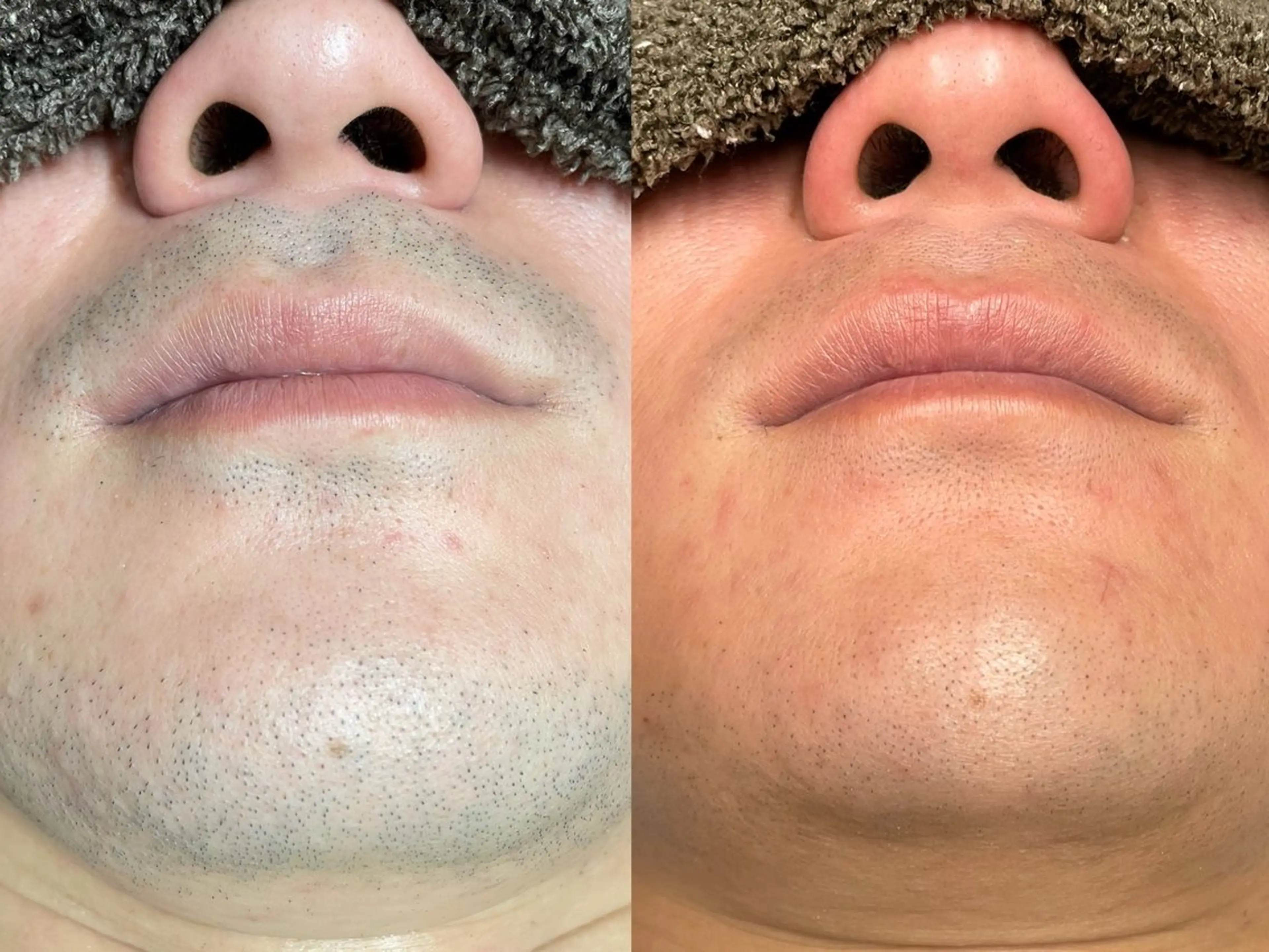 [髭剃りによる肌荒れ卒業🎓]ひげ脱毛⭐️の写真