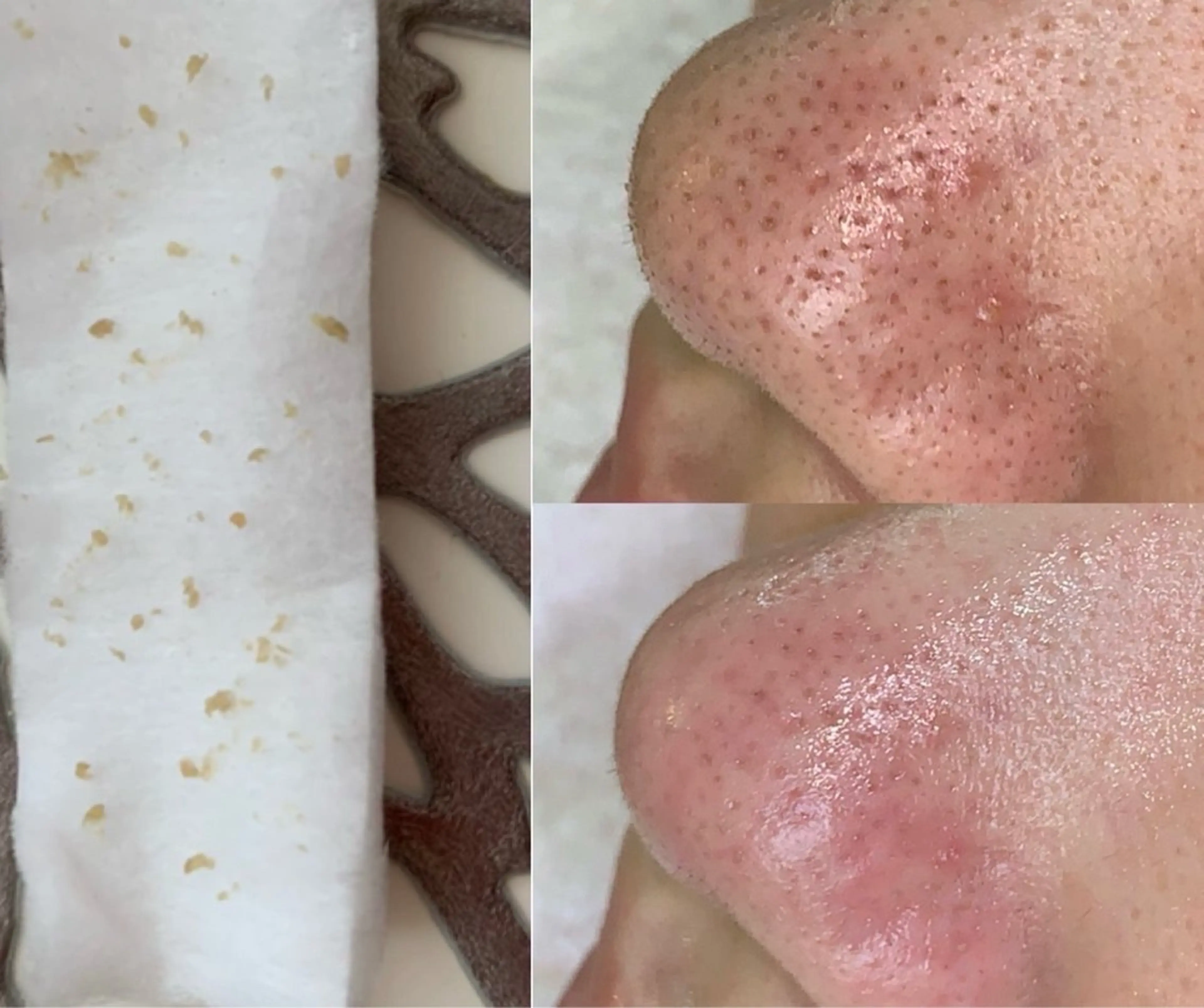 【期間限定|特別価格✨】毛穴改善|毛穴エクストラクション|tete式の写真