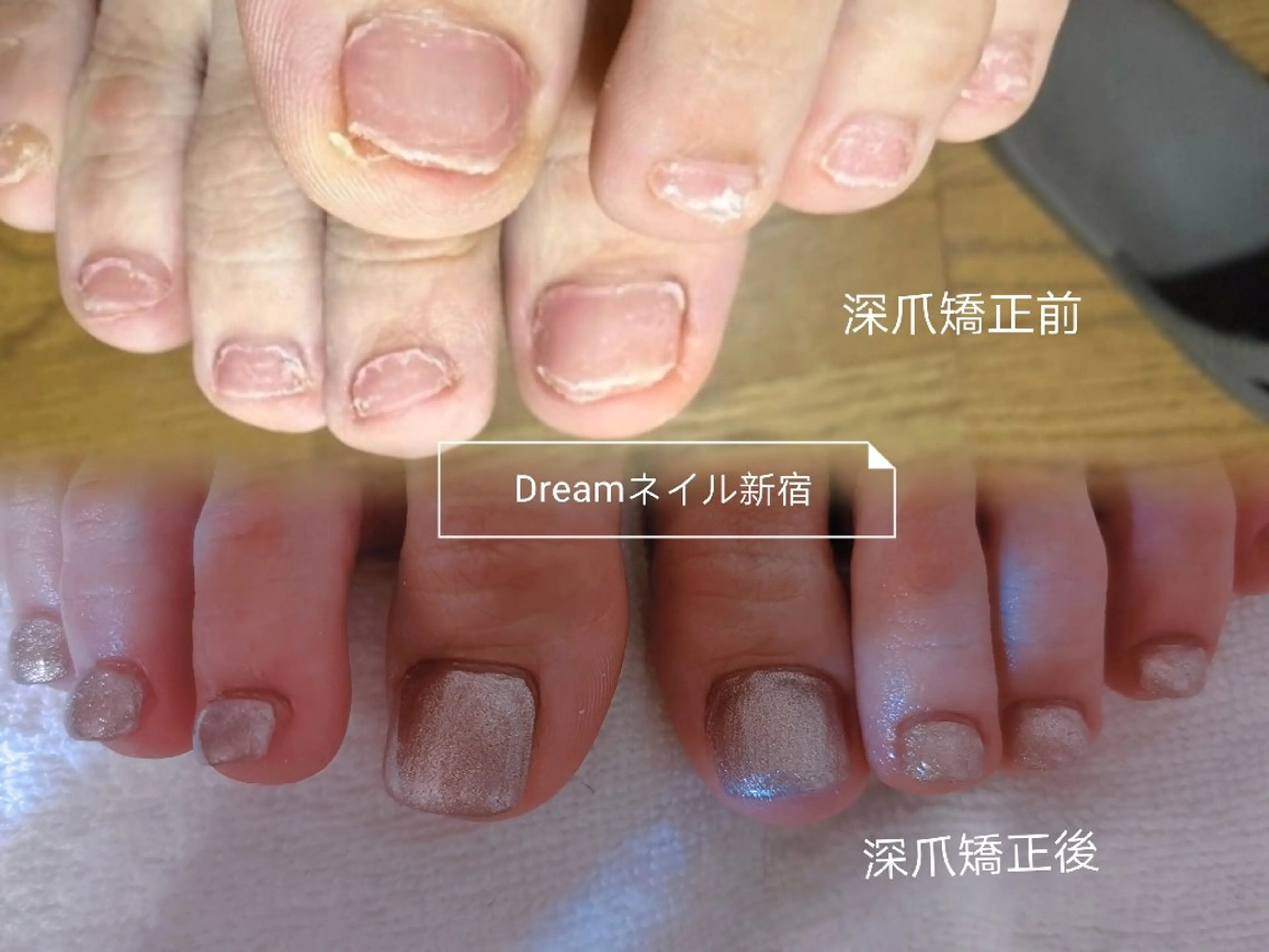 ネイル フットネイル ネイリストゆか💅 長さだし、深爪矯正のネイルデザイン