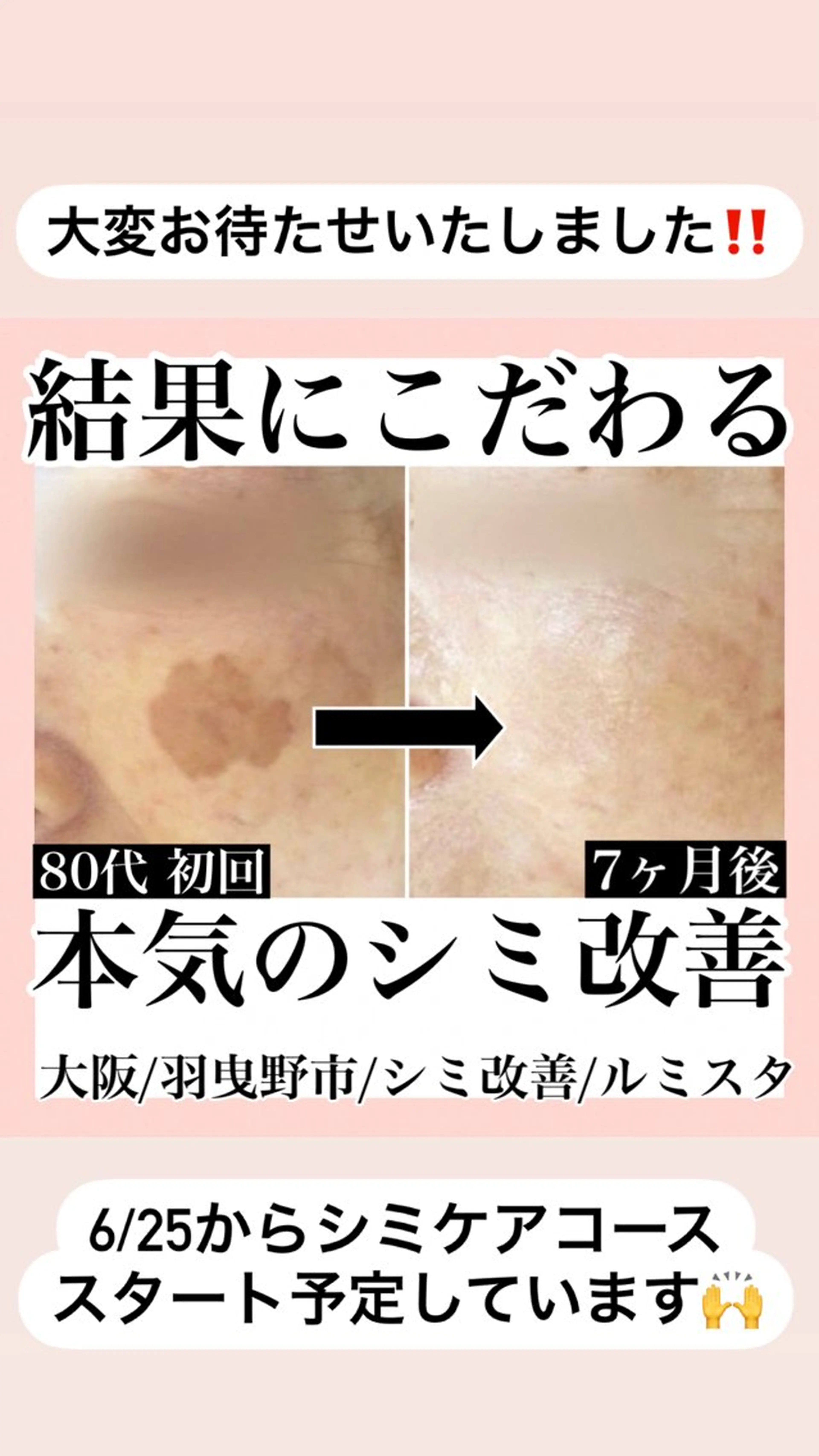 シミケア取り放題 モニター特別価格の写真