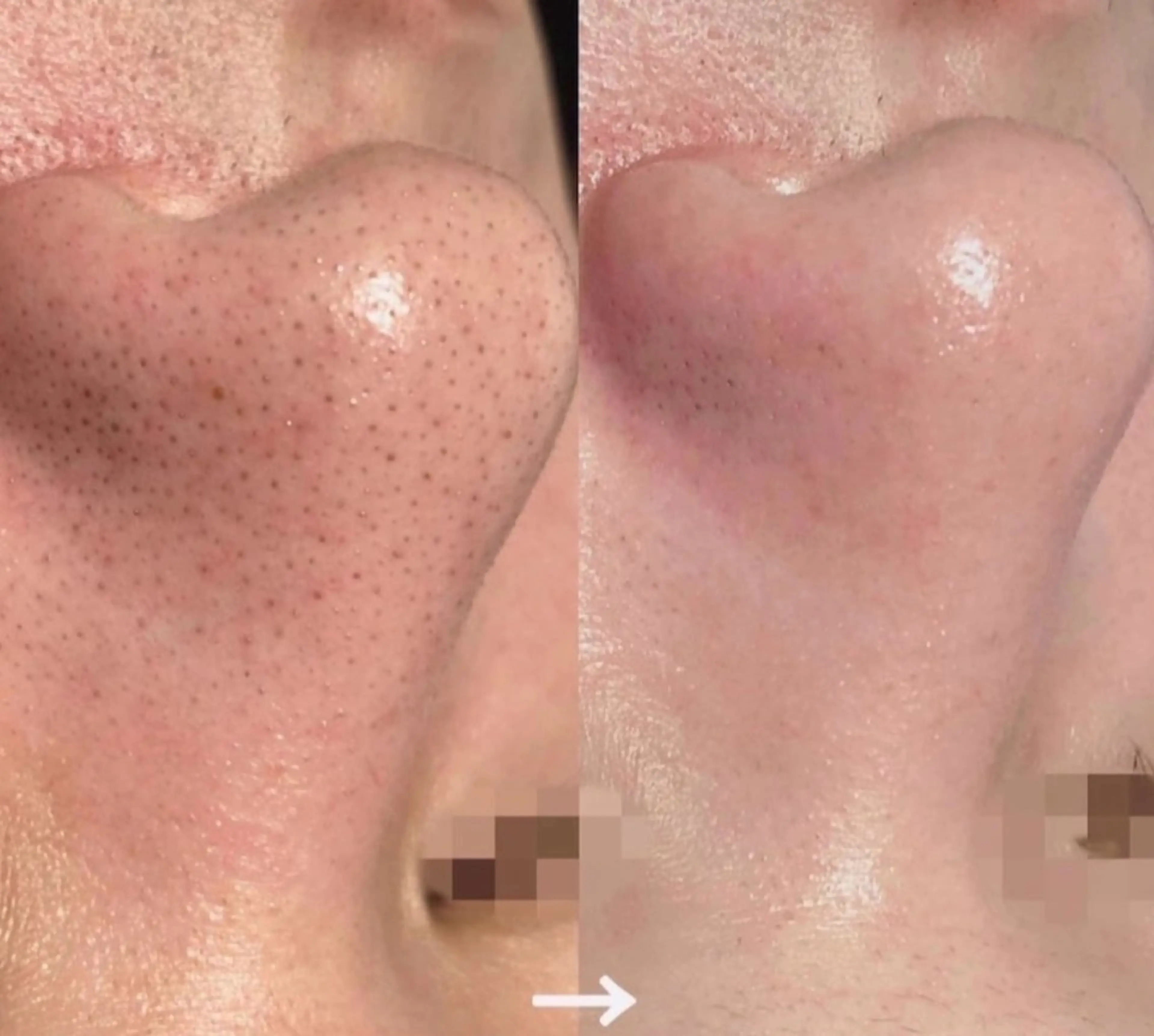 韓国毛穴洗浄(毛穴光フェイシャル+ヘッドマッサージ付) +角質ケア　60分の写真