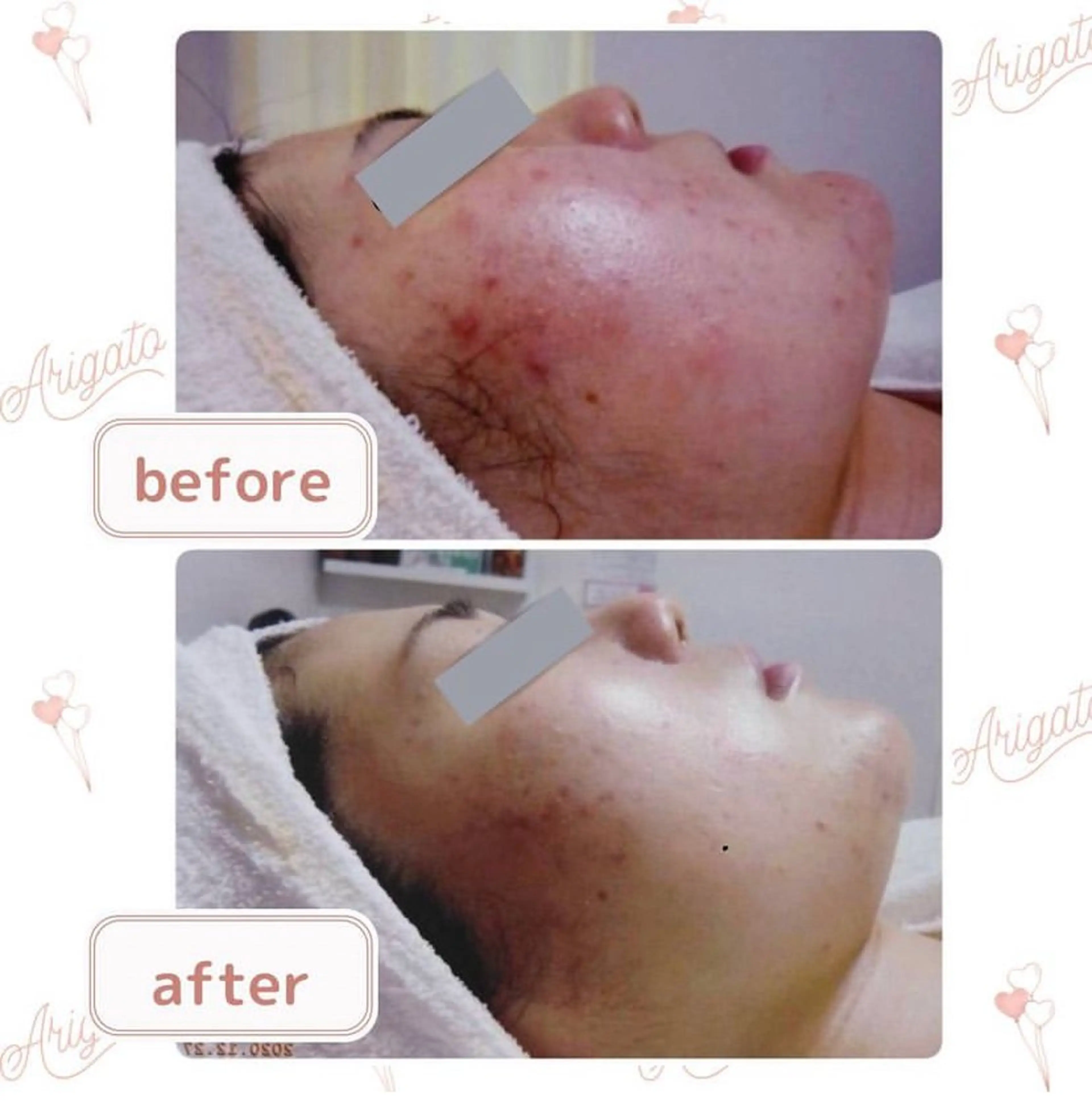 ニキビケア◇ニキビ跡 レゾン京橋店 八崎のエステ・リラクイメージ