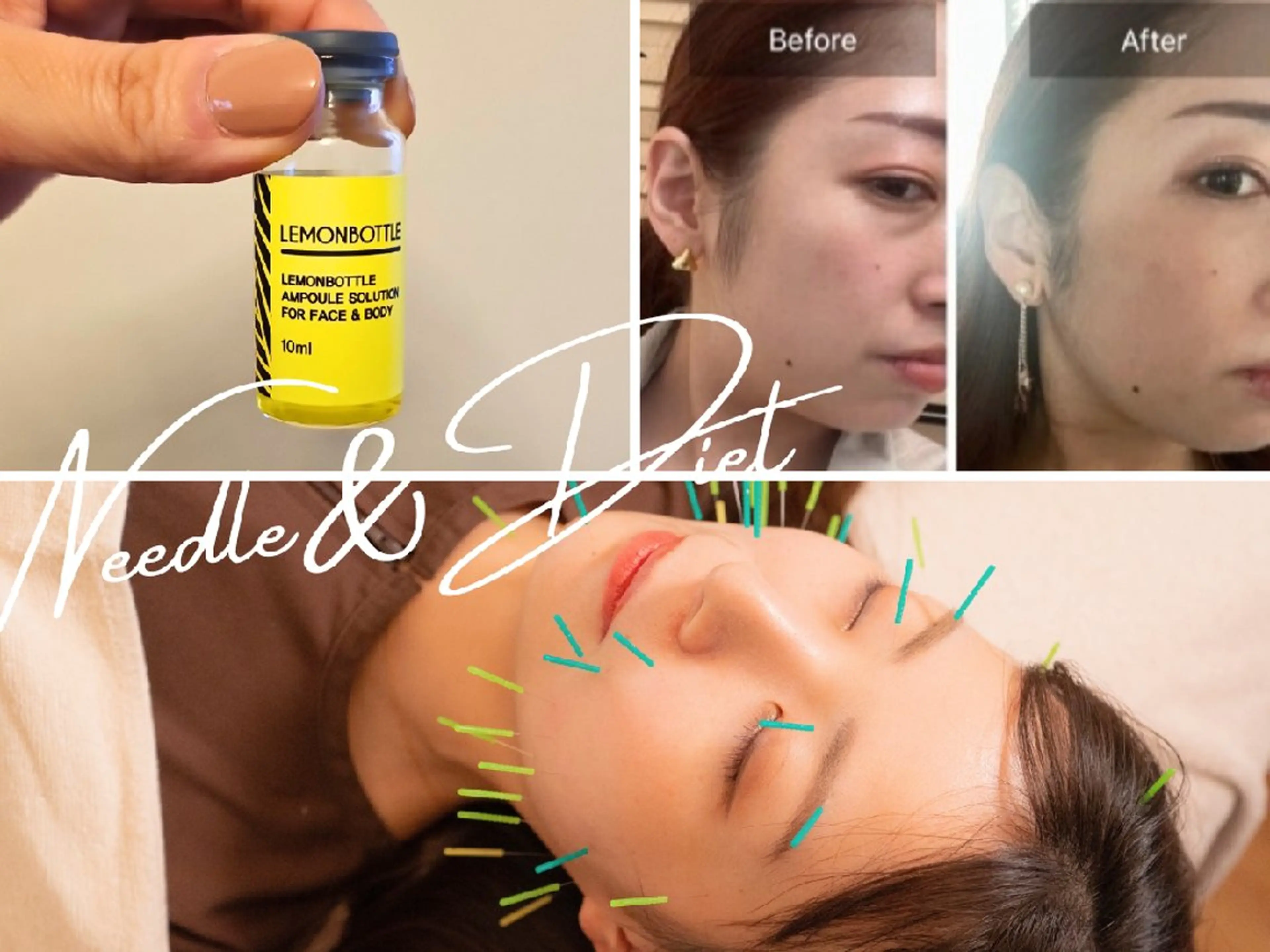 【脂肪がなくなる!?美容鍼】鍼灸初！脂肪サヨナラ👋美容鍼｜クリニックじゃなくて夢は叶う✨両頬・二重顎をスッキリ！の写真