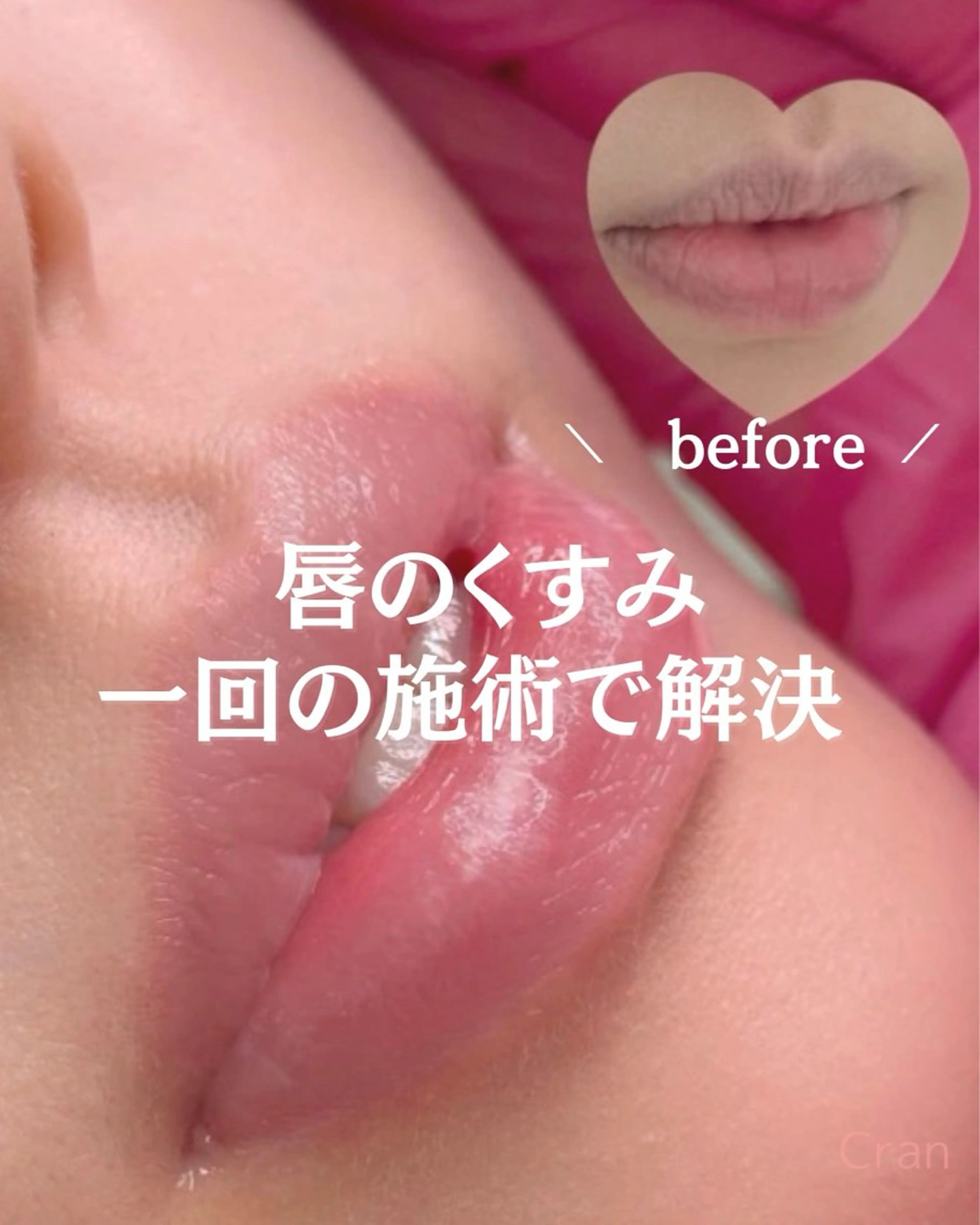 注目📣💋くすみ　黒ずみ　メラニン除去💋ローマピンクの写真