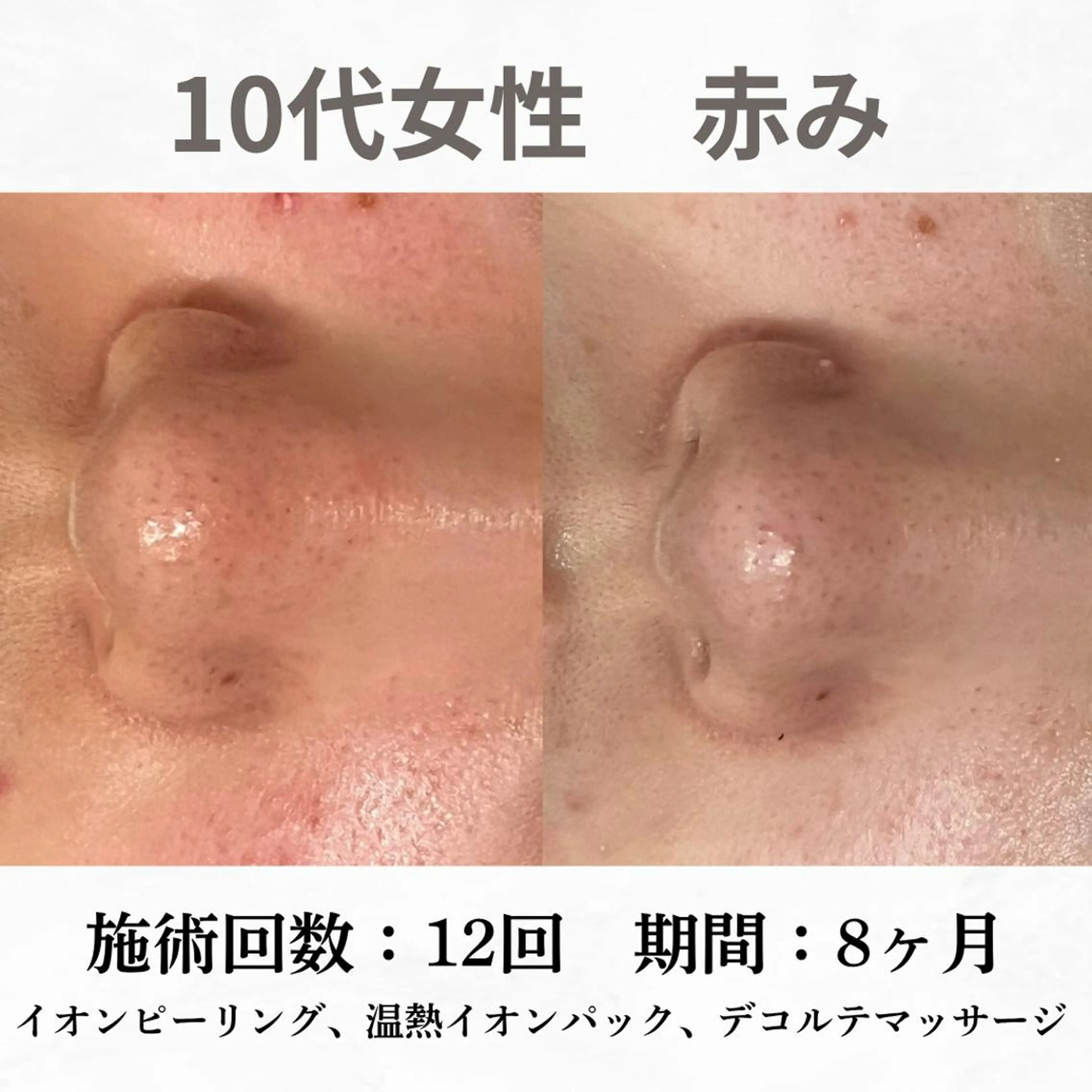 重度ニキビ専門🌷 ダウンタイムなしのエステ・リラクイメージ