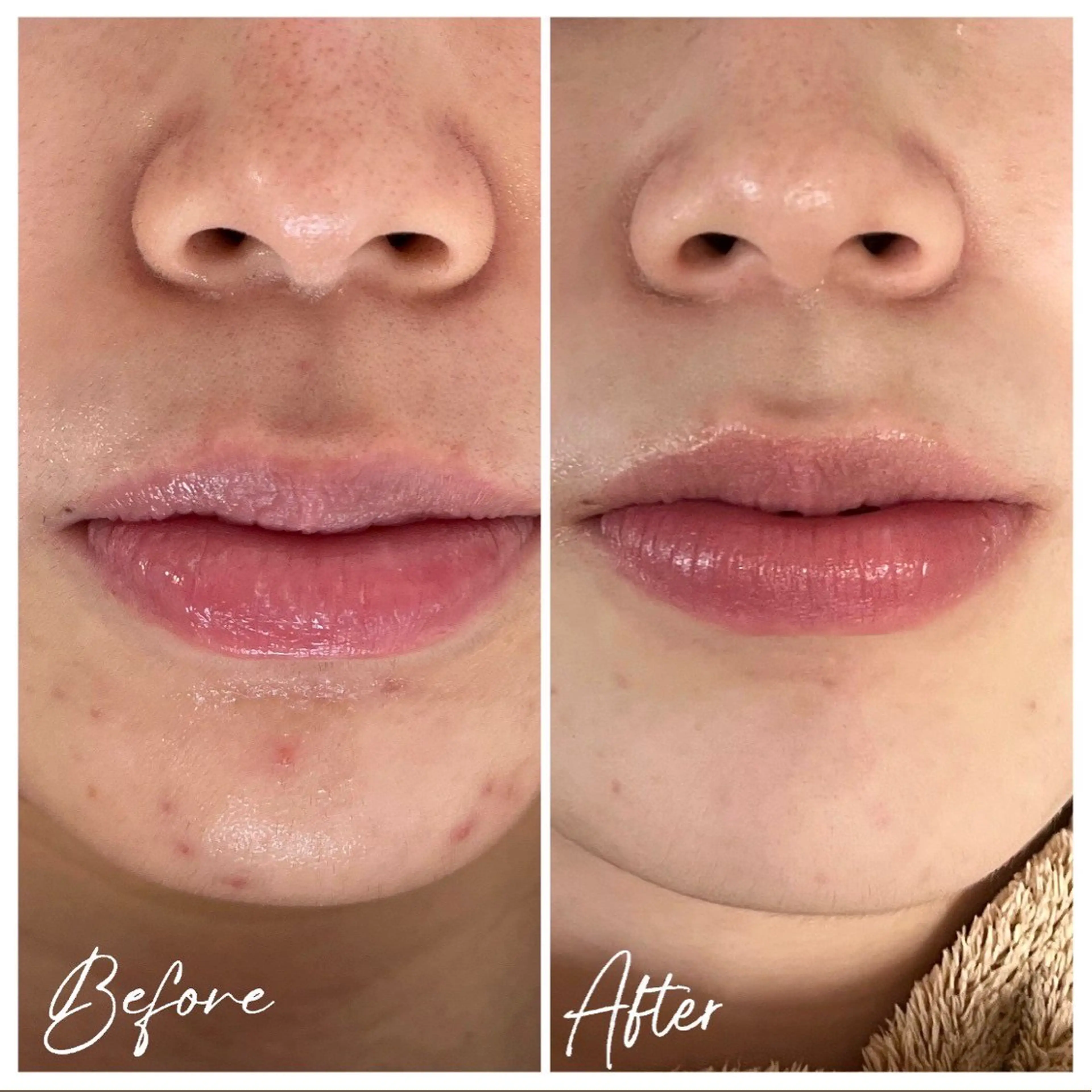 【顔◆人気No.1】剥けるハーブピーリングx鎮静パックの写真