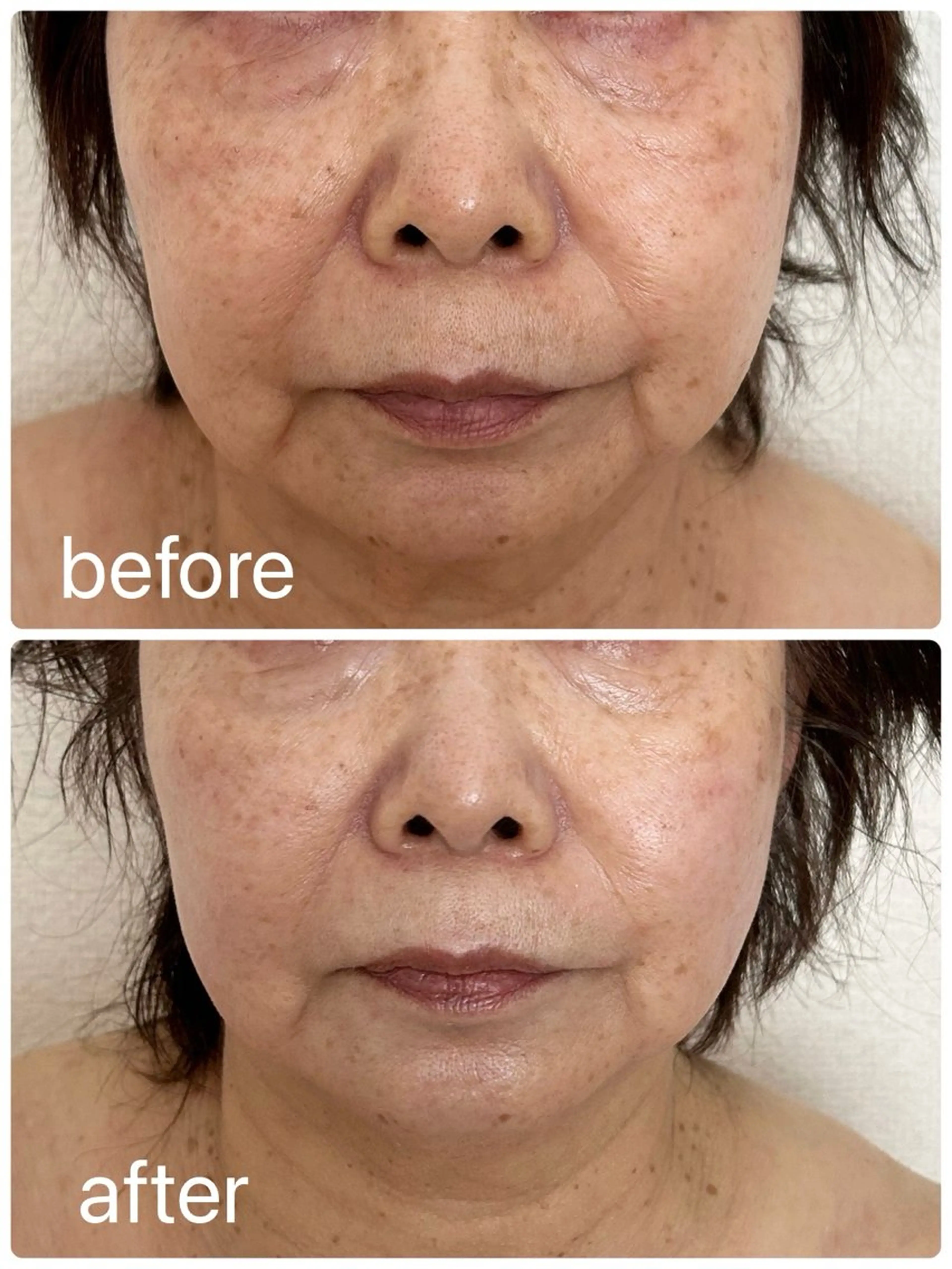 お肌のボリューム不足/ほうれい線が目立つ/ゴルゴラインやマリオネットラインが気になる/フェイスラインがすっきりしないの写真