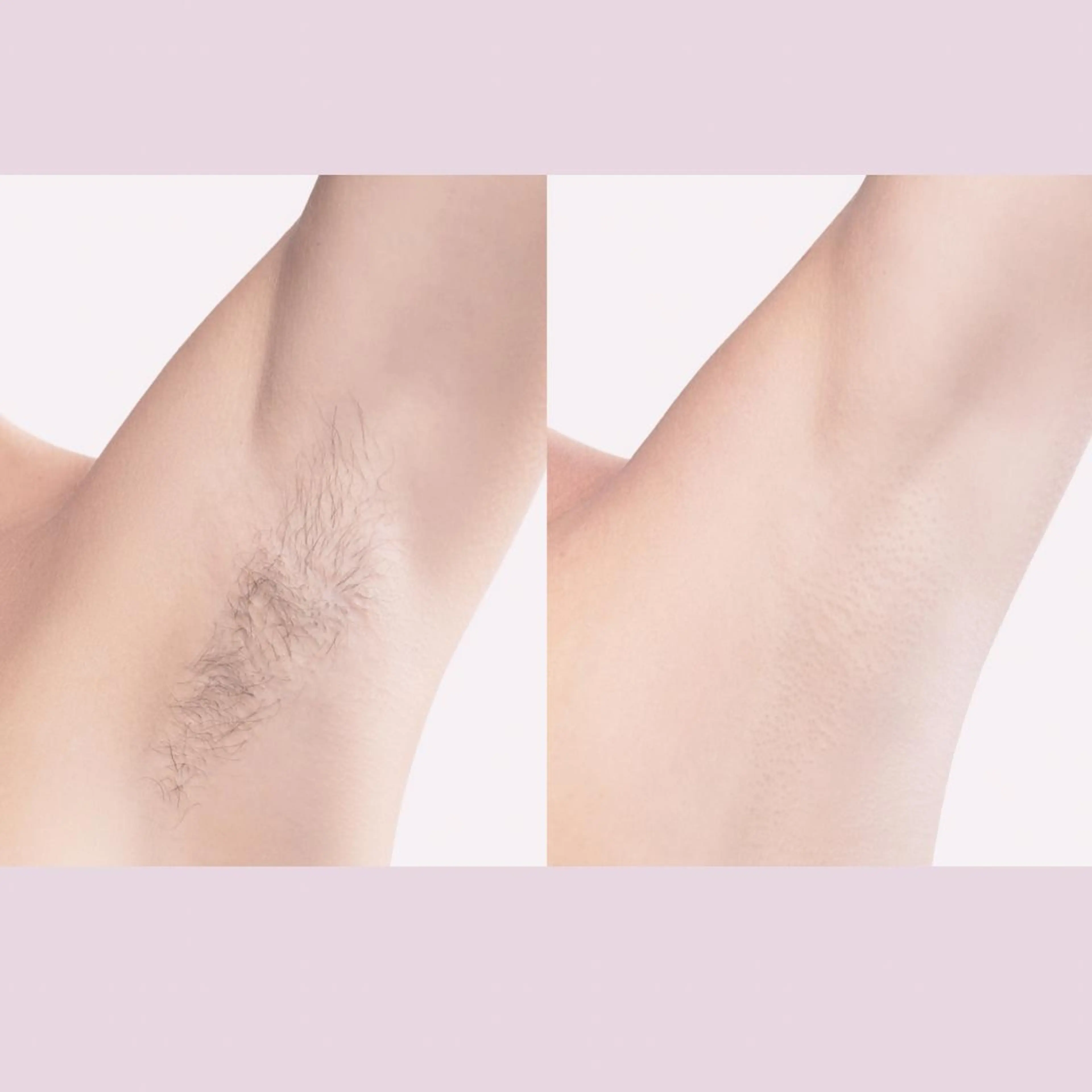 脱毛 脱毛専門店 Angemのエステ・リラクイメージ