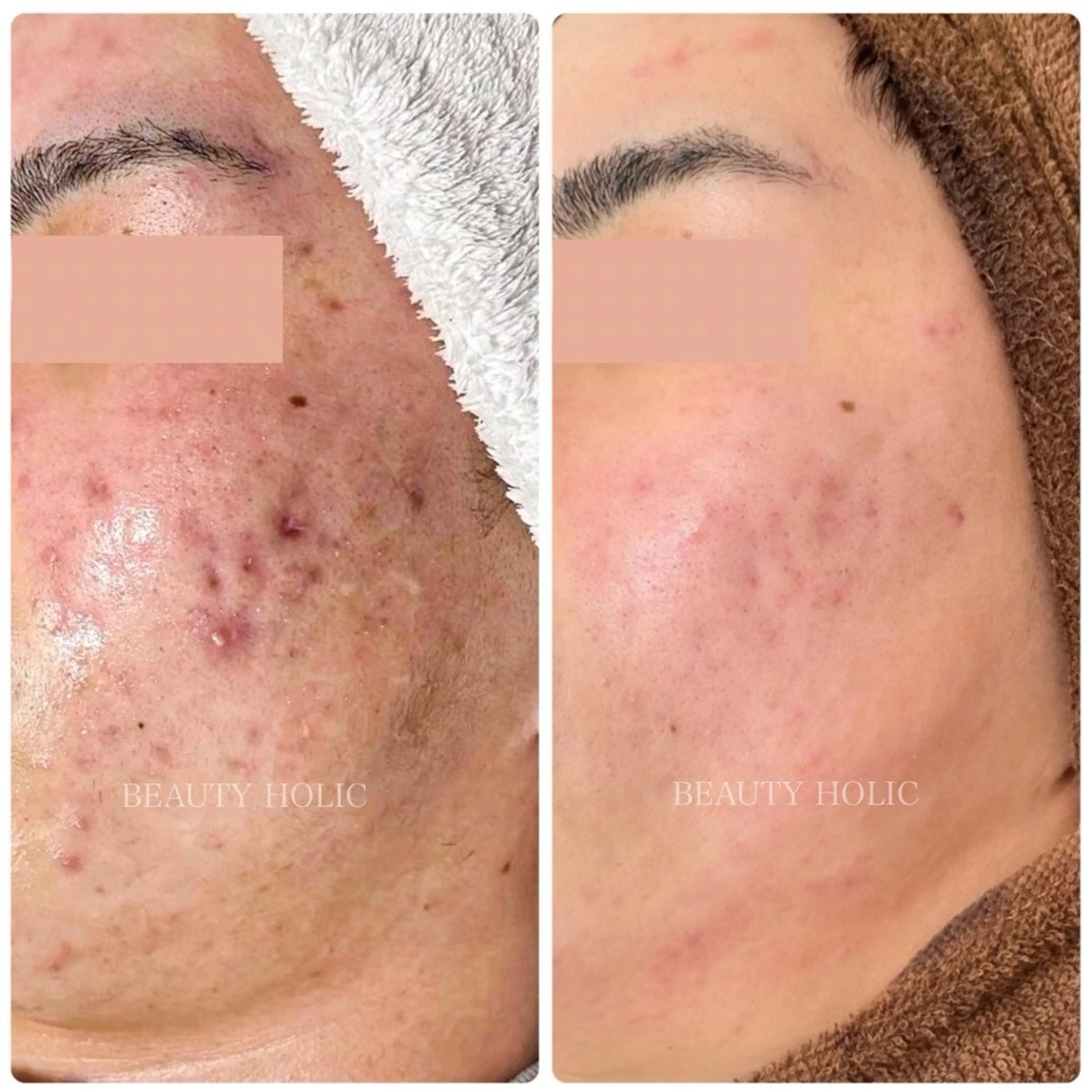 メンズニキビ|大人ニキビ|肌荒れ|誰にも相談できない繰り返すニキビ|男性の為のニキビケア体験✨の写真