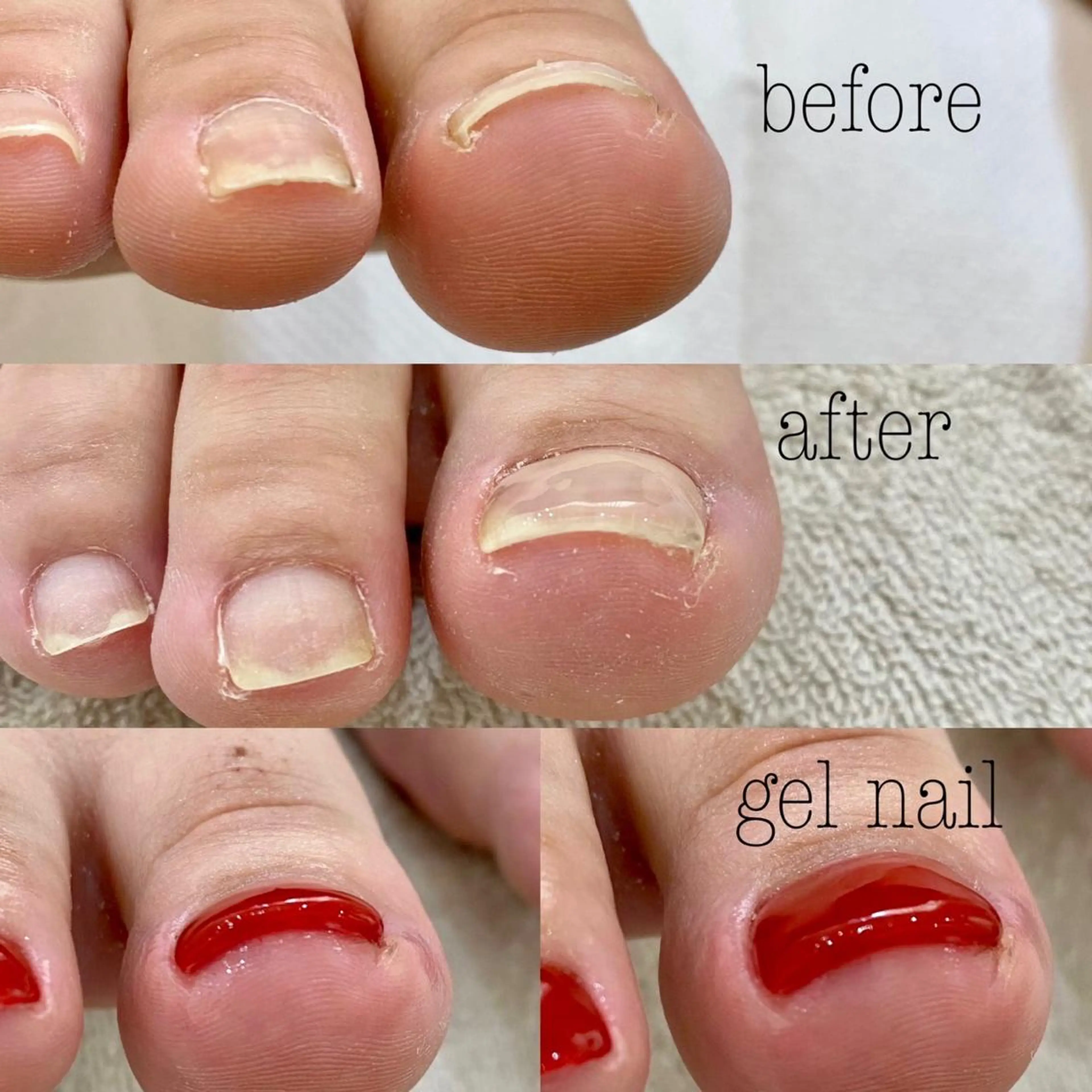 巻き爪矯正✨親指2本＋ワンカラー🌈の写真