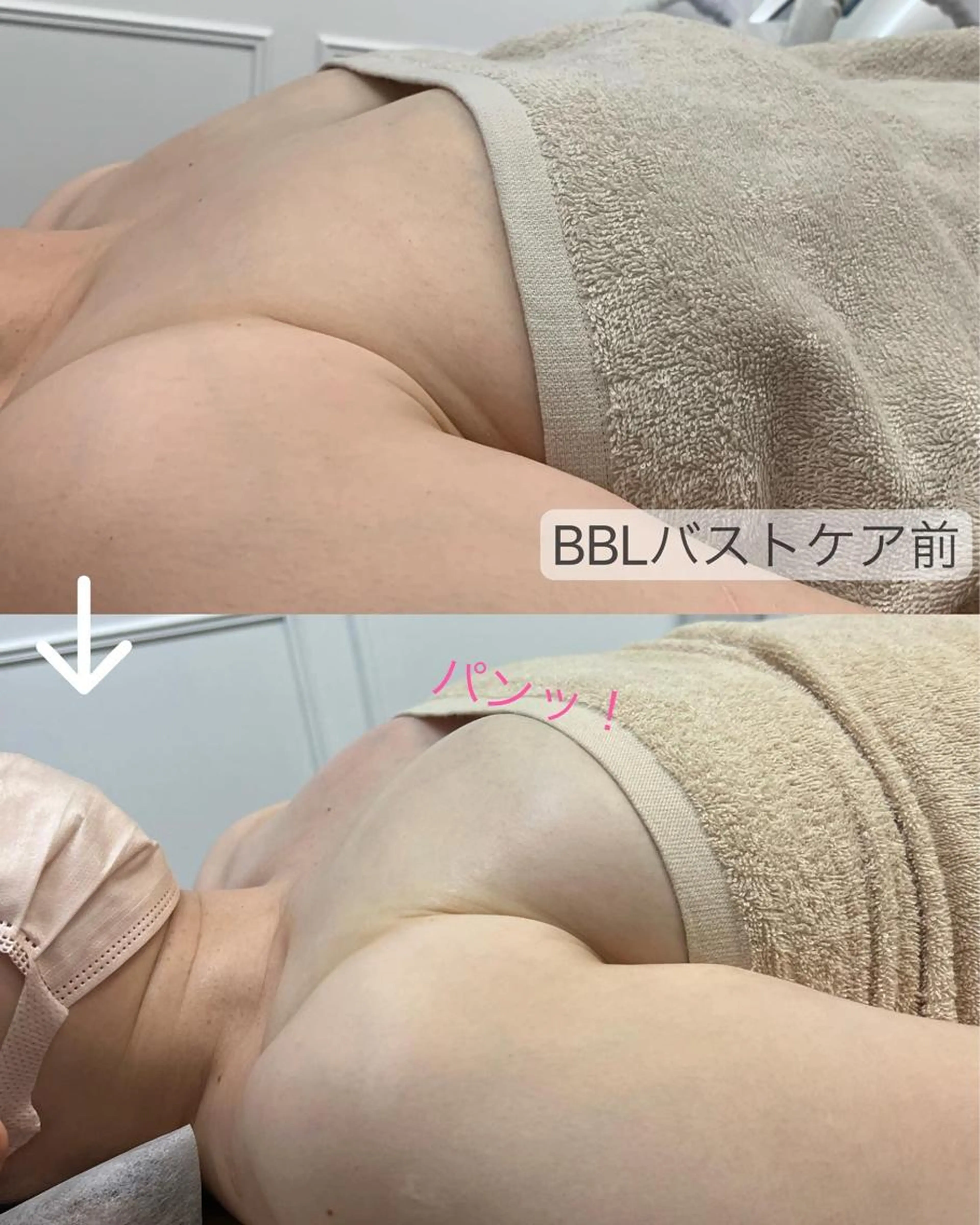 BBL光バストアップケアの写真