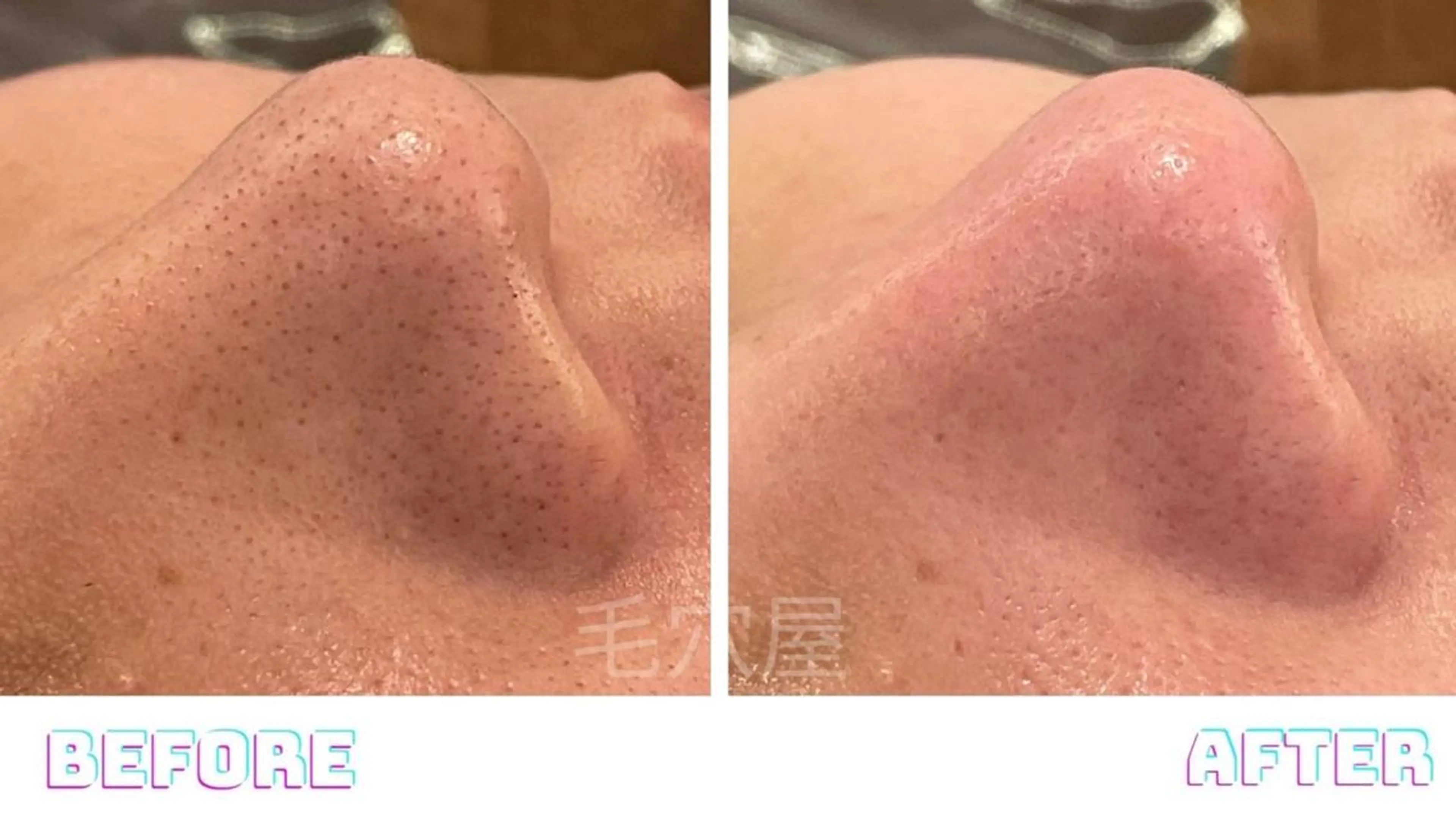 エステ 毛穴/毛穴洗浄専門 エミルカ船橋のエステ・リラクイメージ