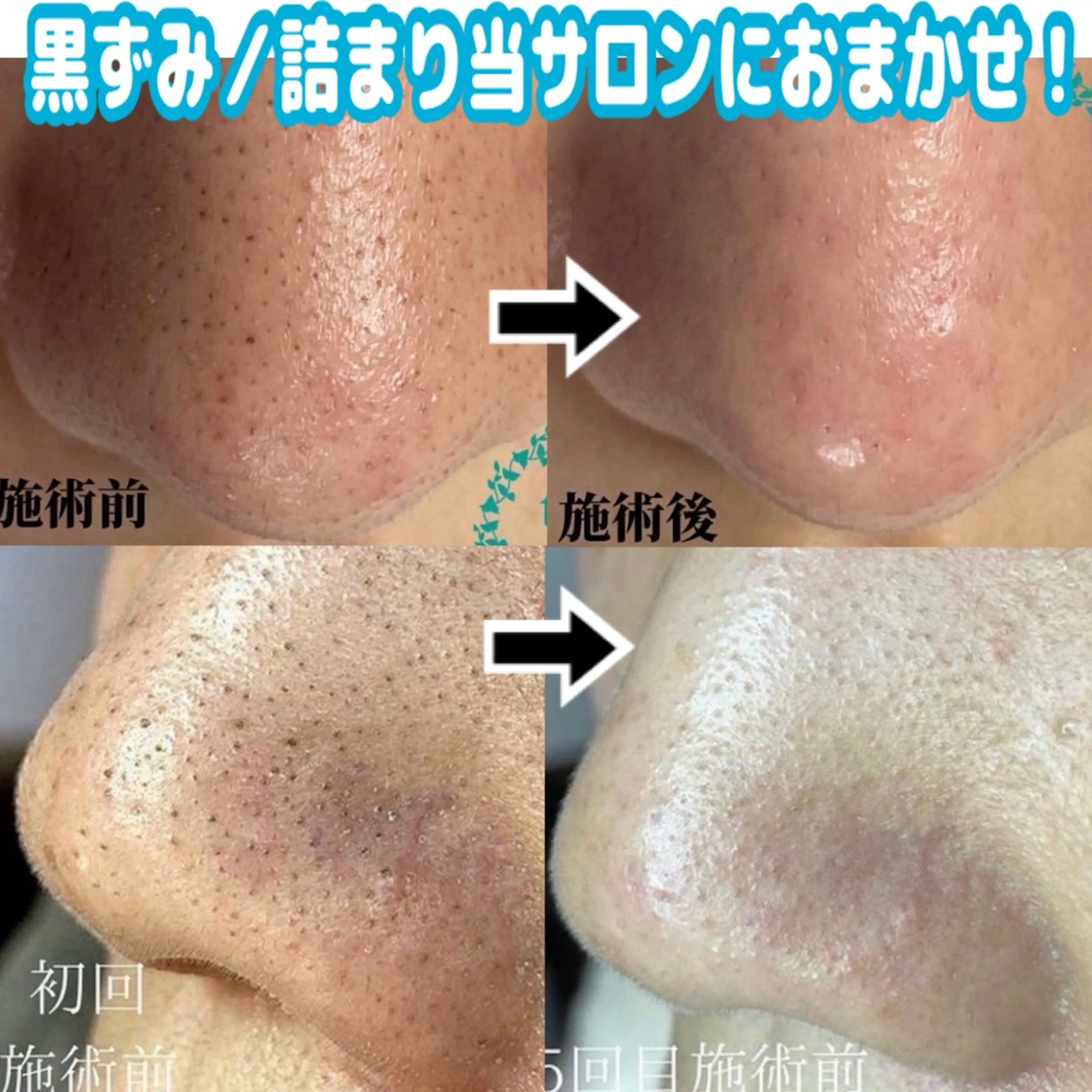 【手軽に♪】黒ずみ・詰まり撃退!鼻特化ケアコース(マッサージ無し)の写真