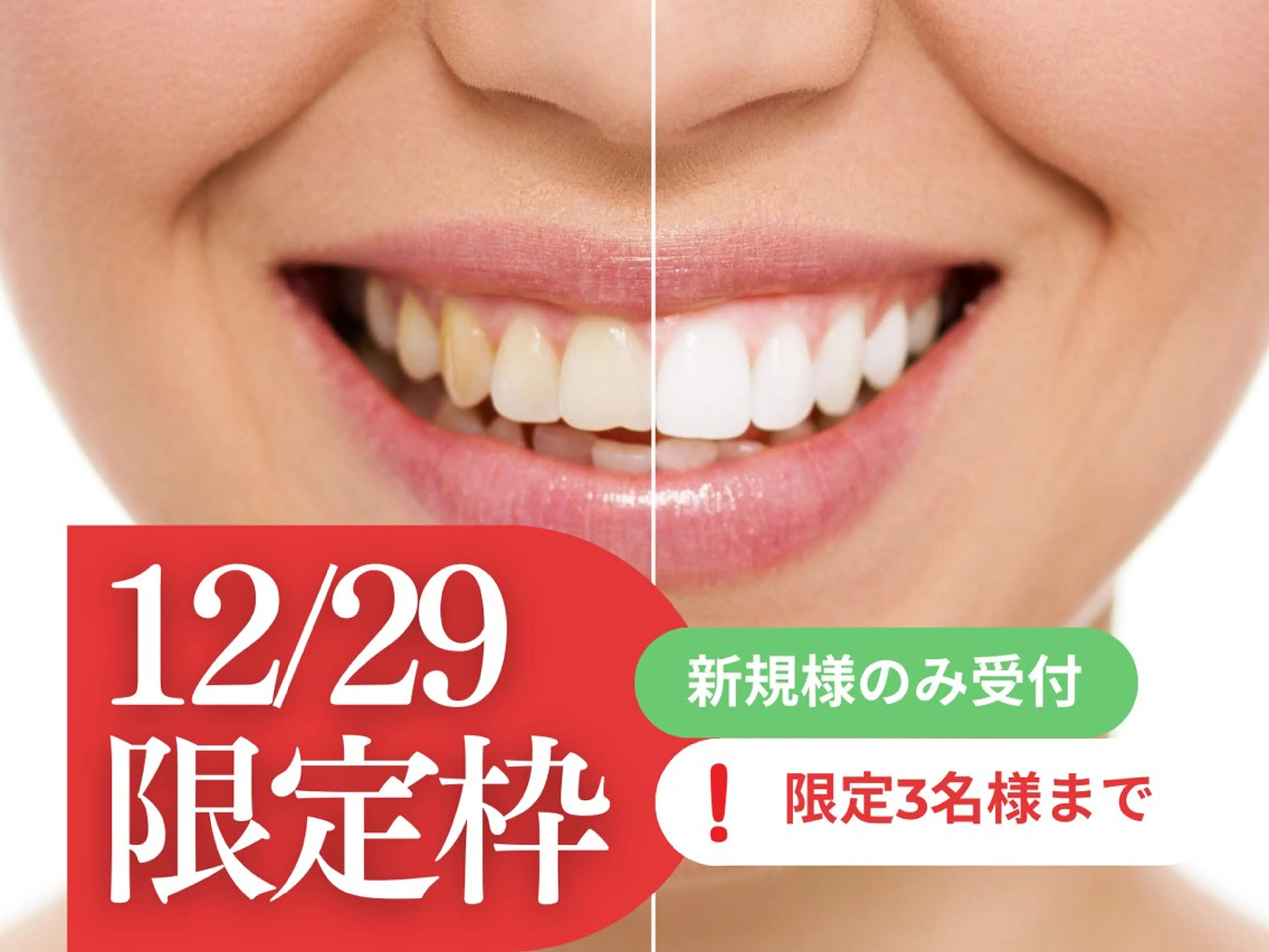 【12/29限定】3名様🦷新規様枠解放！特別年末パック✨️医療用高濃度ジェル使用✨️即日効果実感クーポンの写真