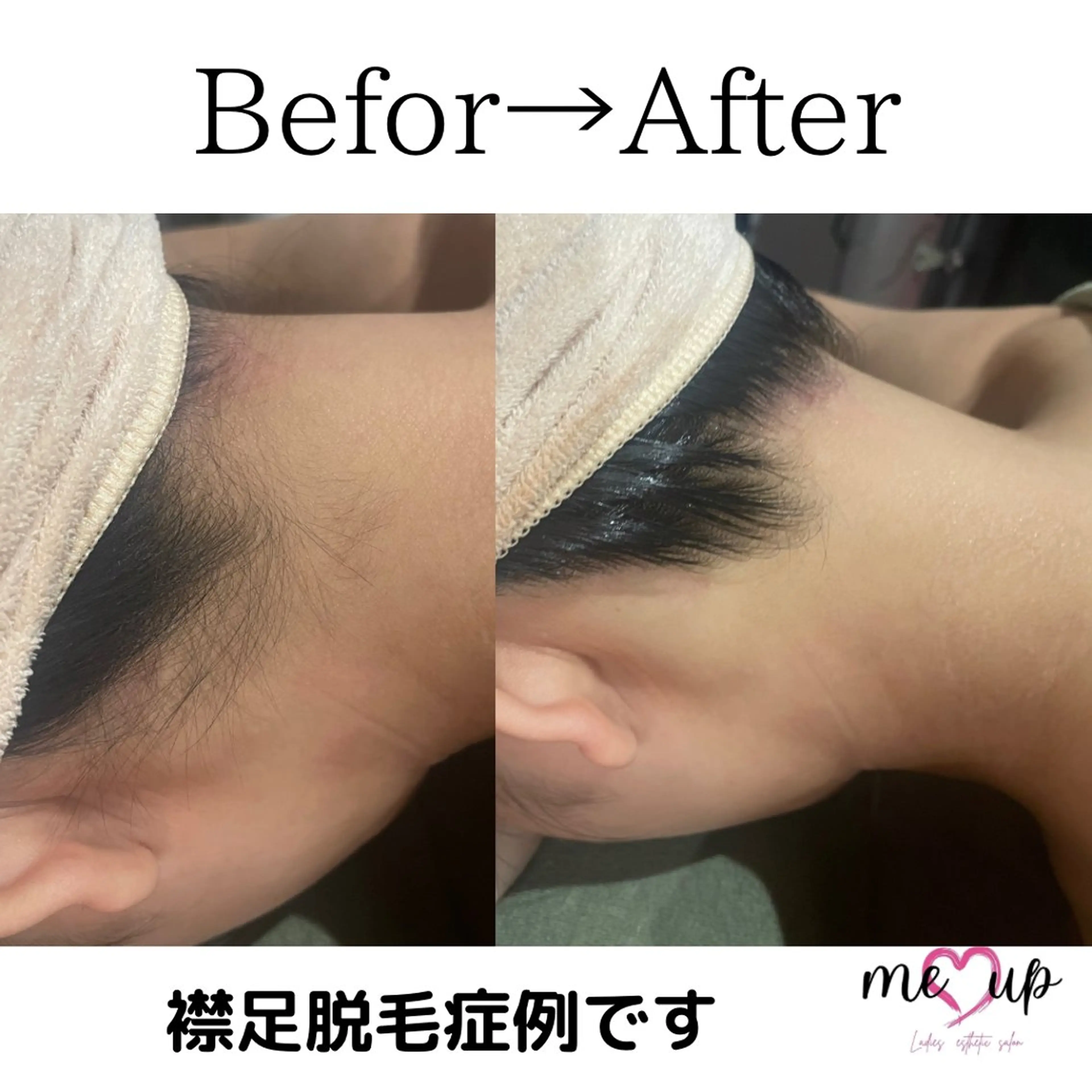 Meupニキビ専門店 背中/ハーブ/肌管理のその他イメージ