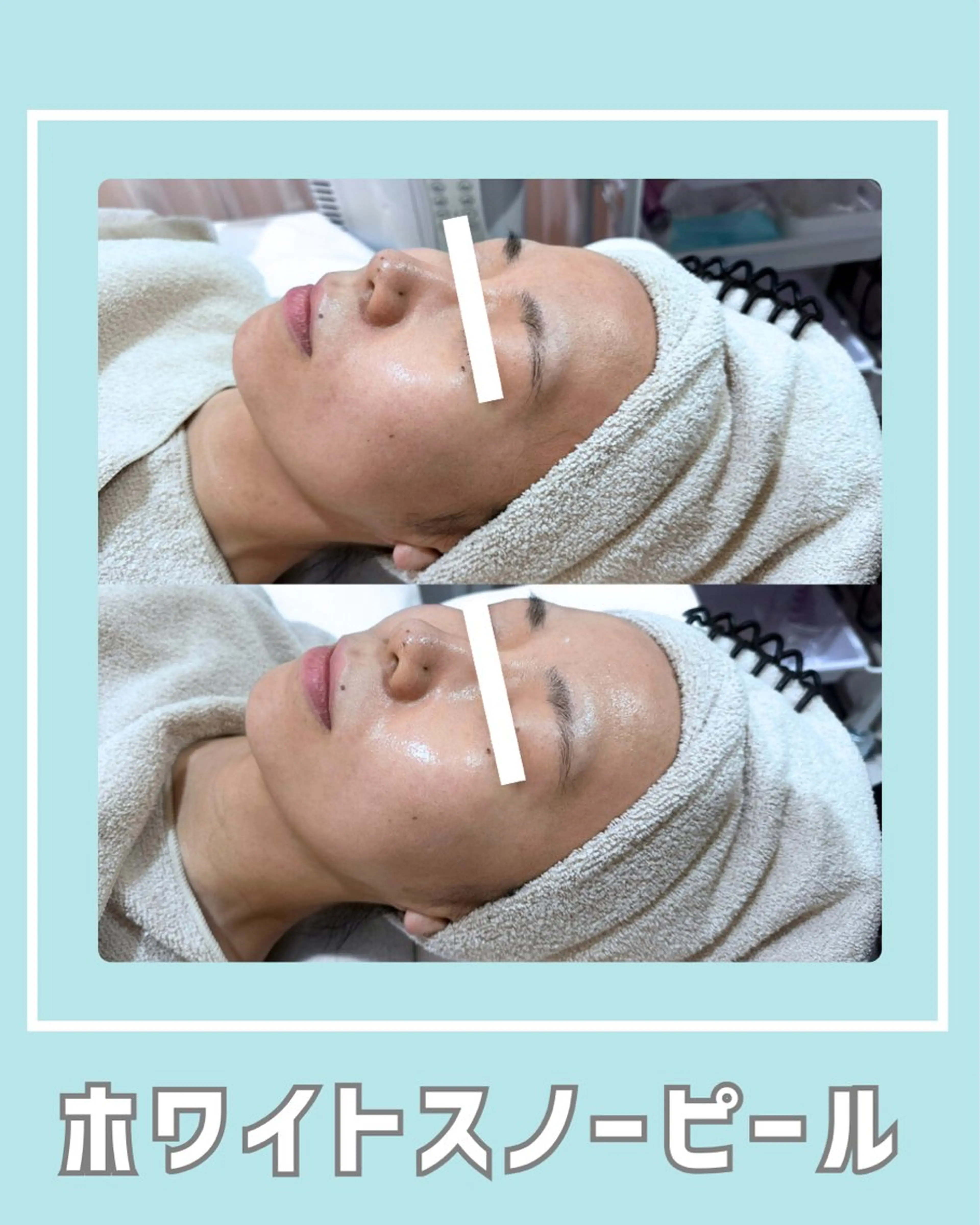 エステ |ピーリング・毛穴| soina神楽坂のエステ・リラクイメージ