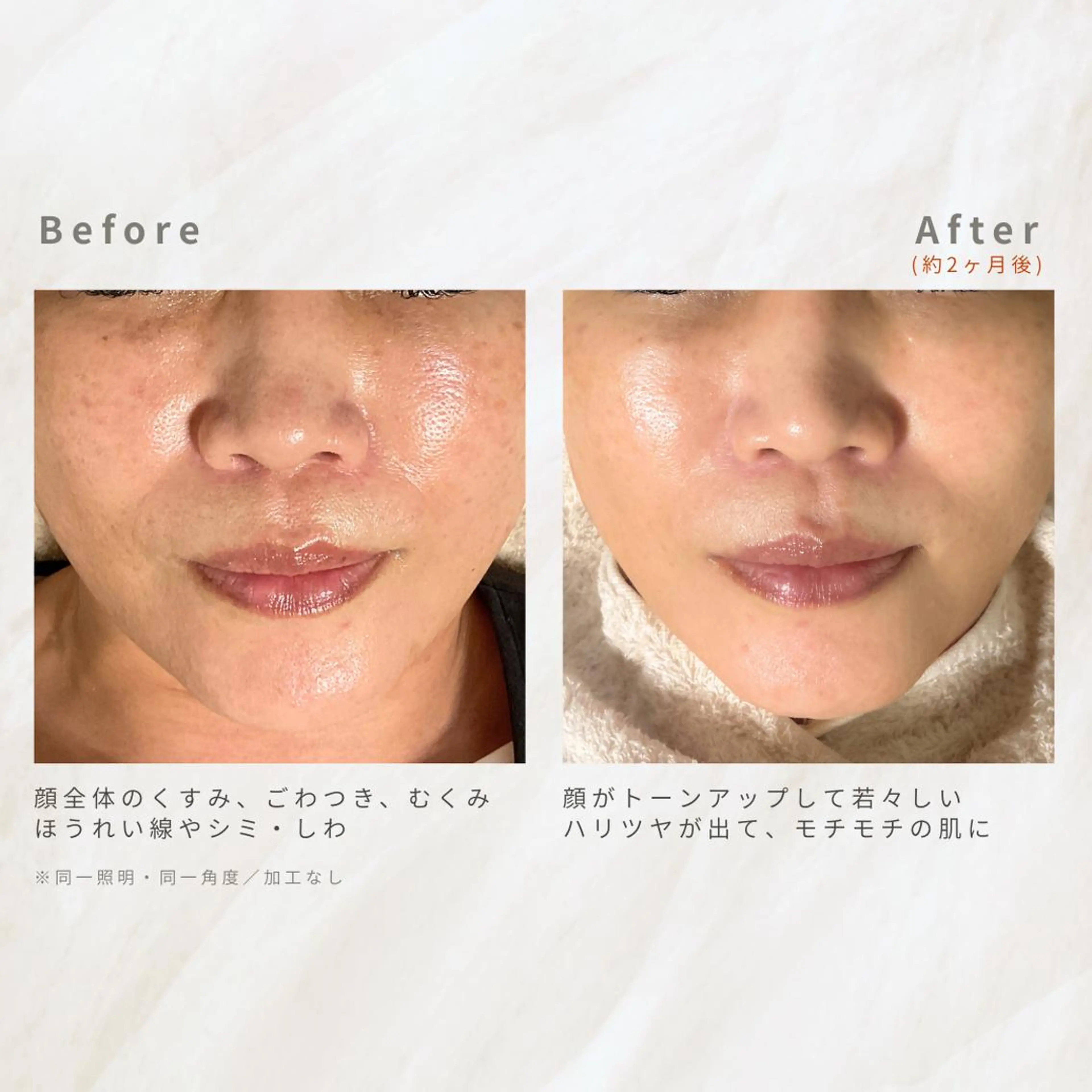 繰り返すニキビを改善 ✨つくば肌質改善専門のエステ・リラクイメージ