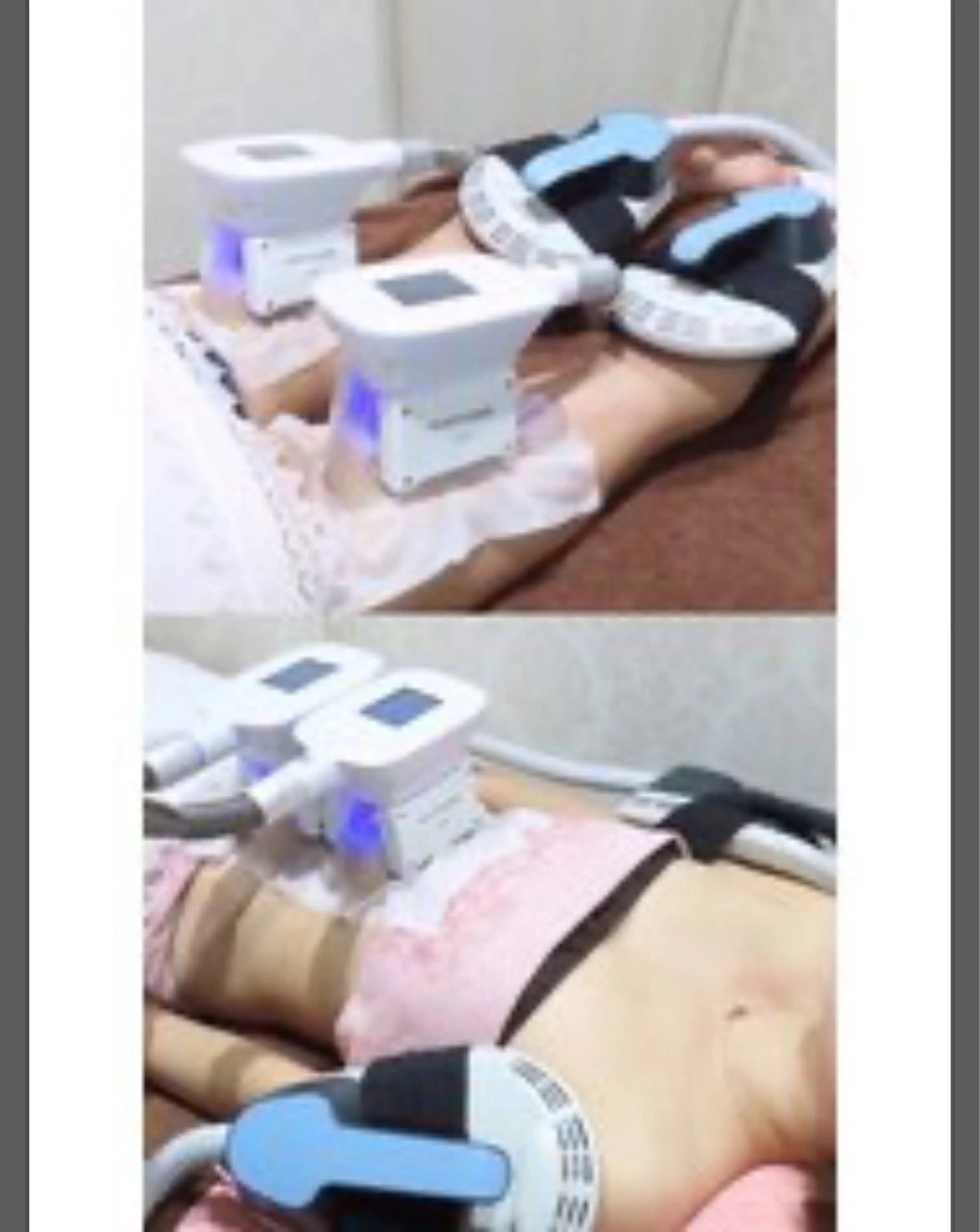 最高峰－12℃冷却痩身＋EMS・キャビテーション付き　　　　　　　　　1部位2カップ施術★キャンペーン価格の写真