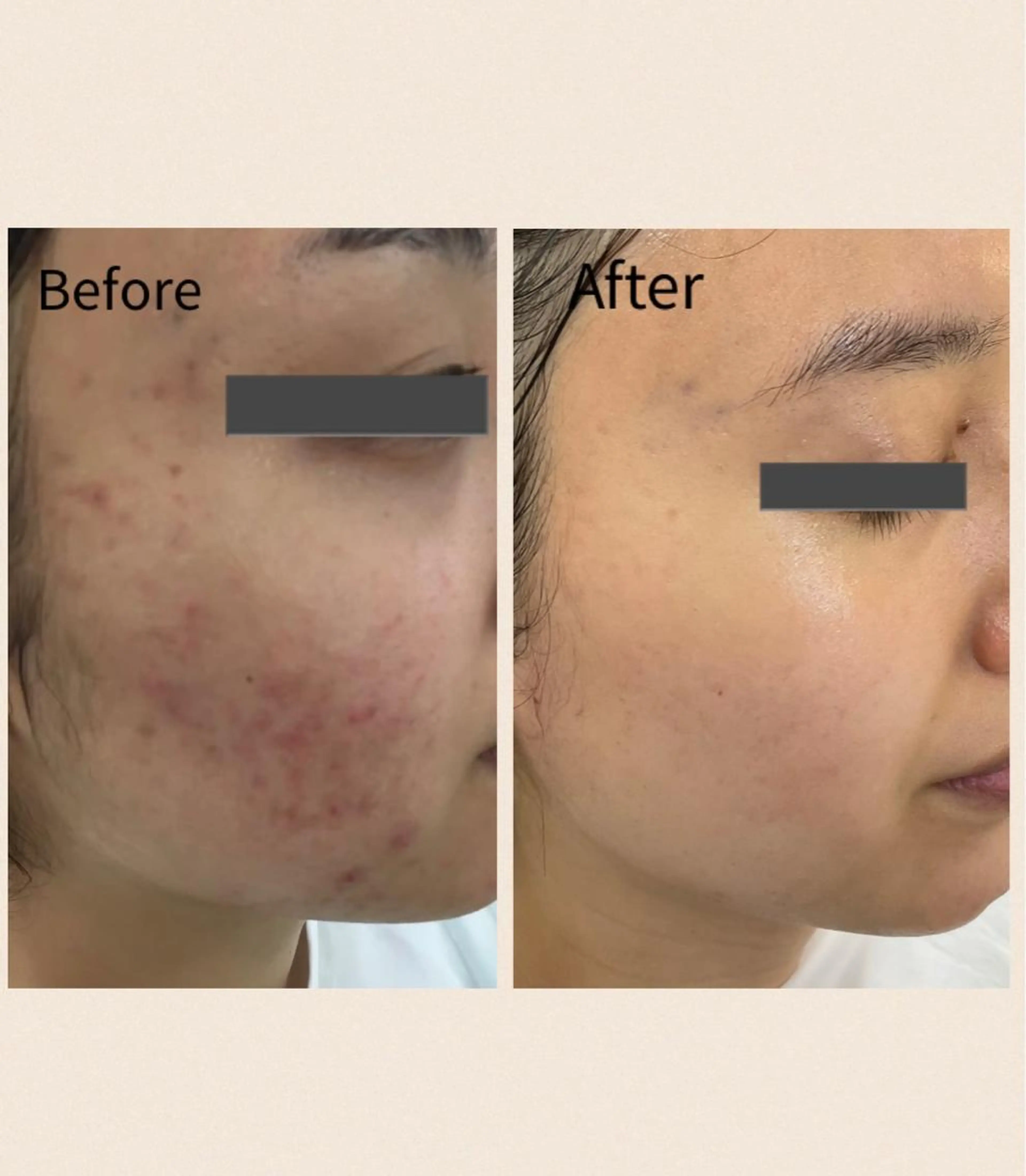 🩵【肌質改善コース】トラブル別メニュー💫の写真