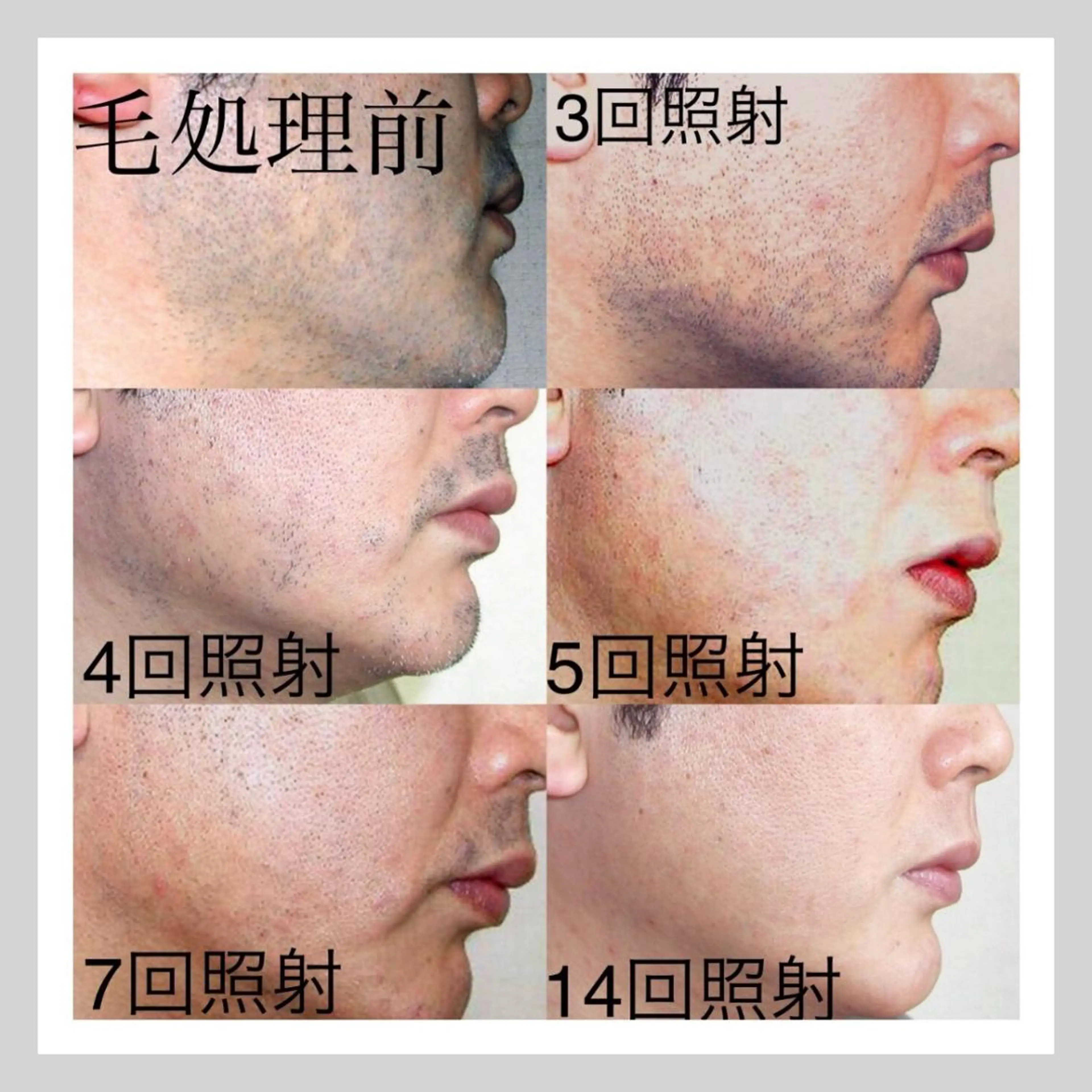 メンズ 脱毛 都度払い脱毛⭐️ 脱毛サロンMIRACのエステ・リラクイメージ