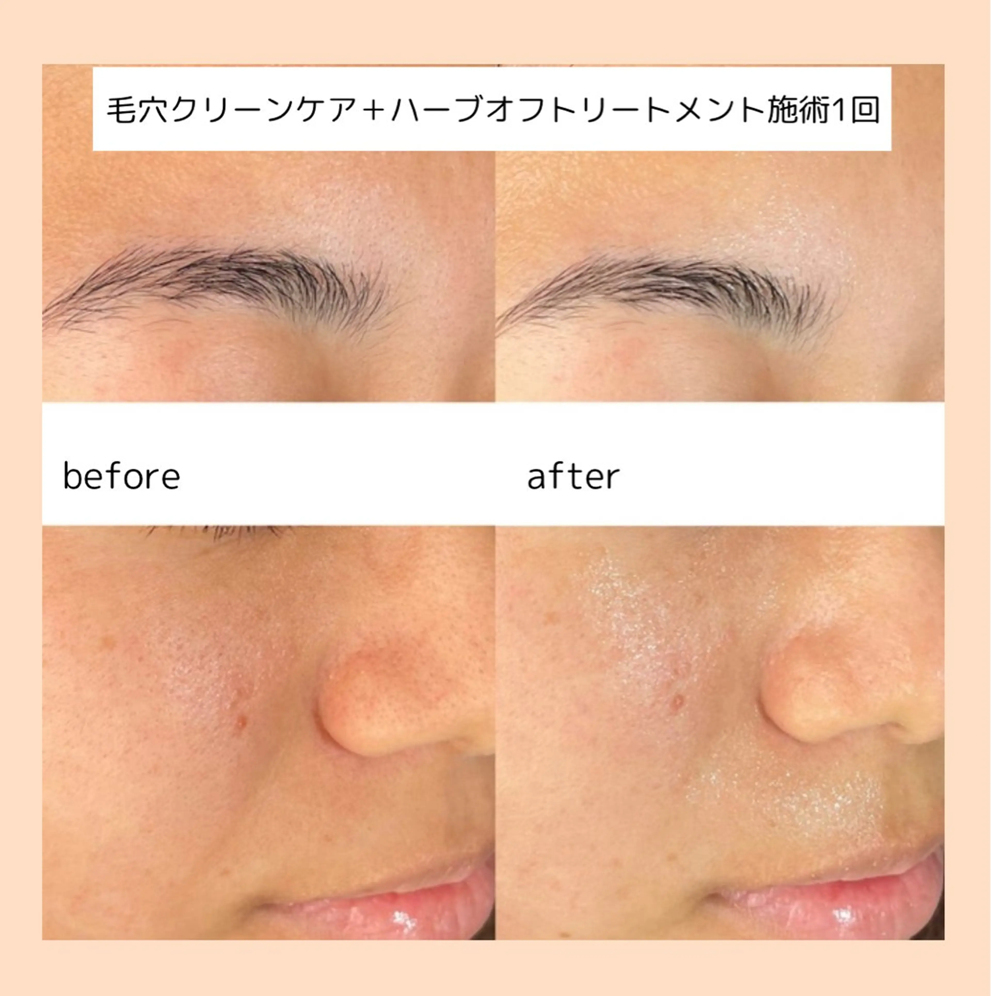 月1回のスペシャルケア🧖🏻♀️人気No1毛穴クリーンケア+贅沢🌿ハーブオフトリートメントの写真