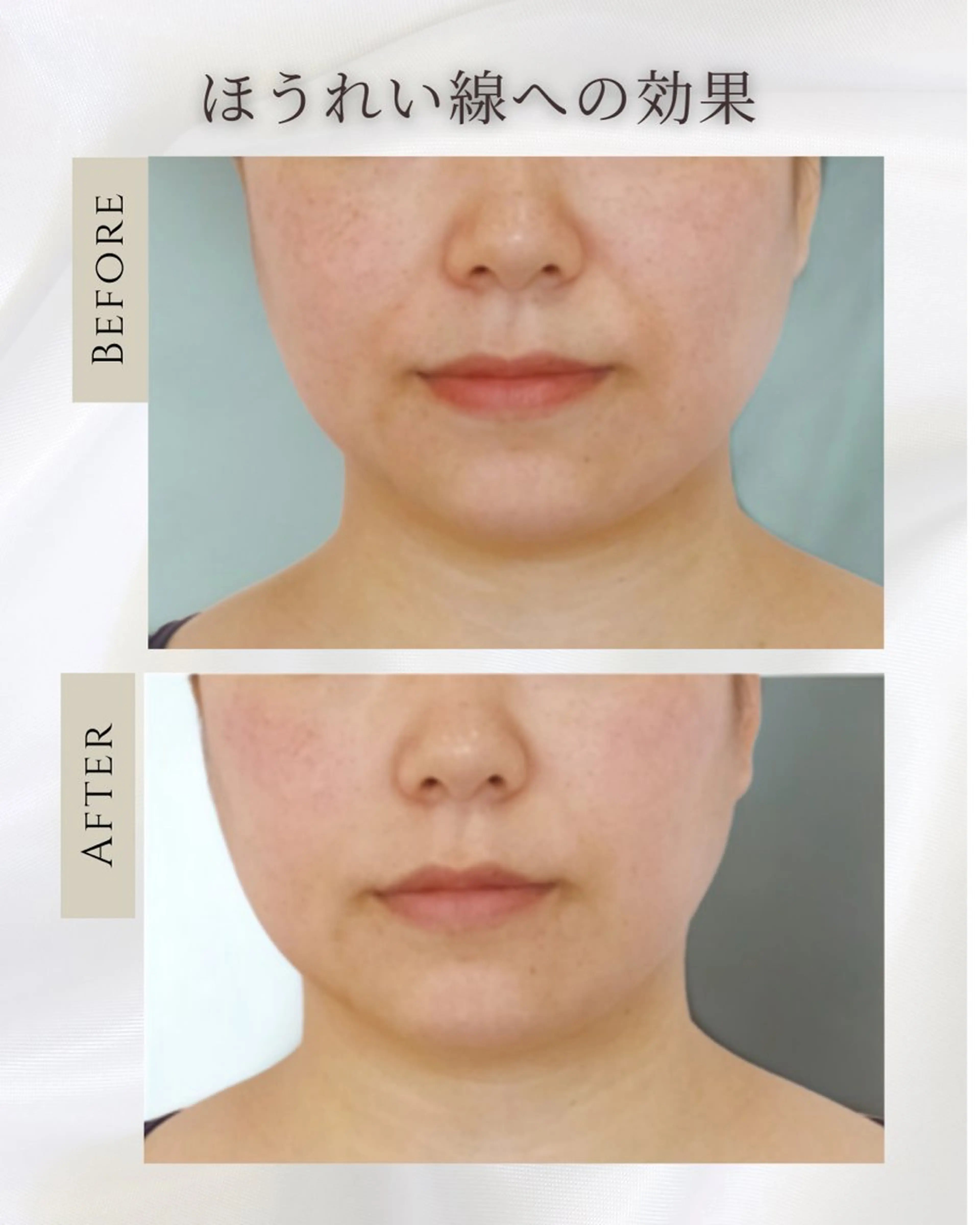 細胞再生修復｜プラズマ×5GF美容×コラーゲンライト×水光リフト【首唇込み】の写真