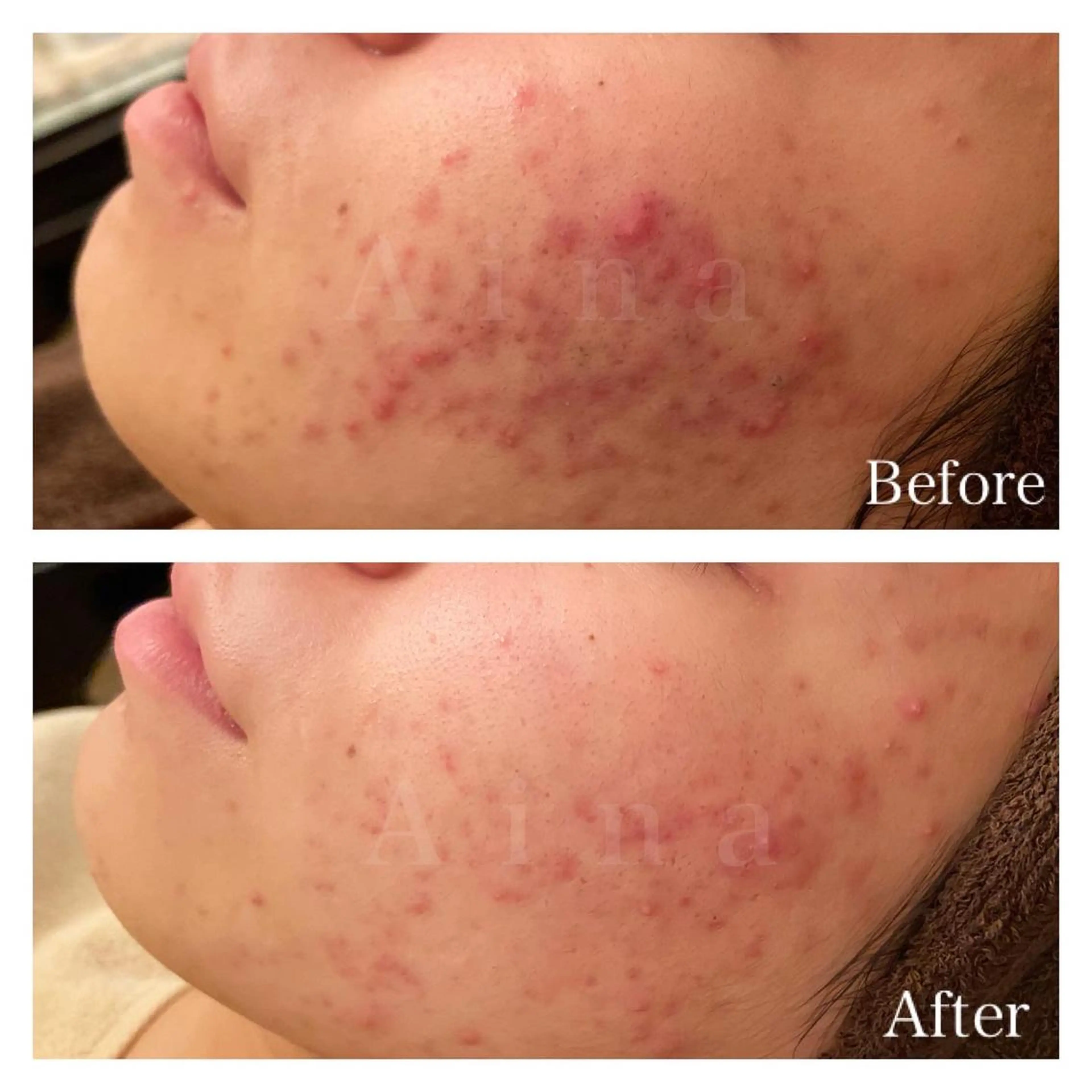 ミディアム カラー パーマ ヘアアレンジ メンズ キッズ ネイル マツエク・マツパ ニキビ跡専門サロン Ａｉｎａのエステ・リラクイメージ