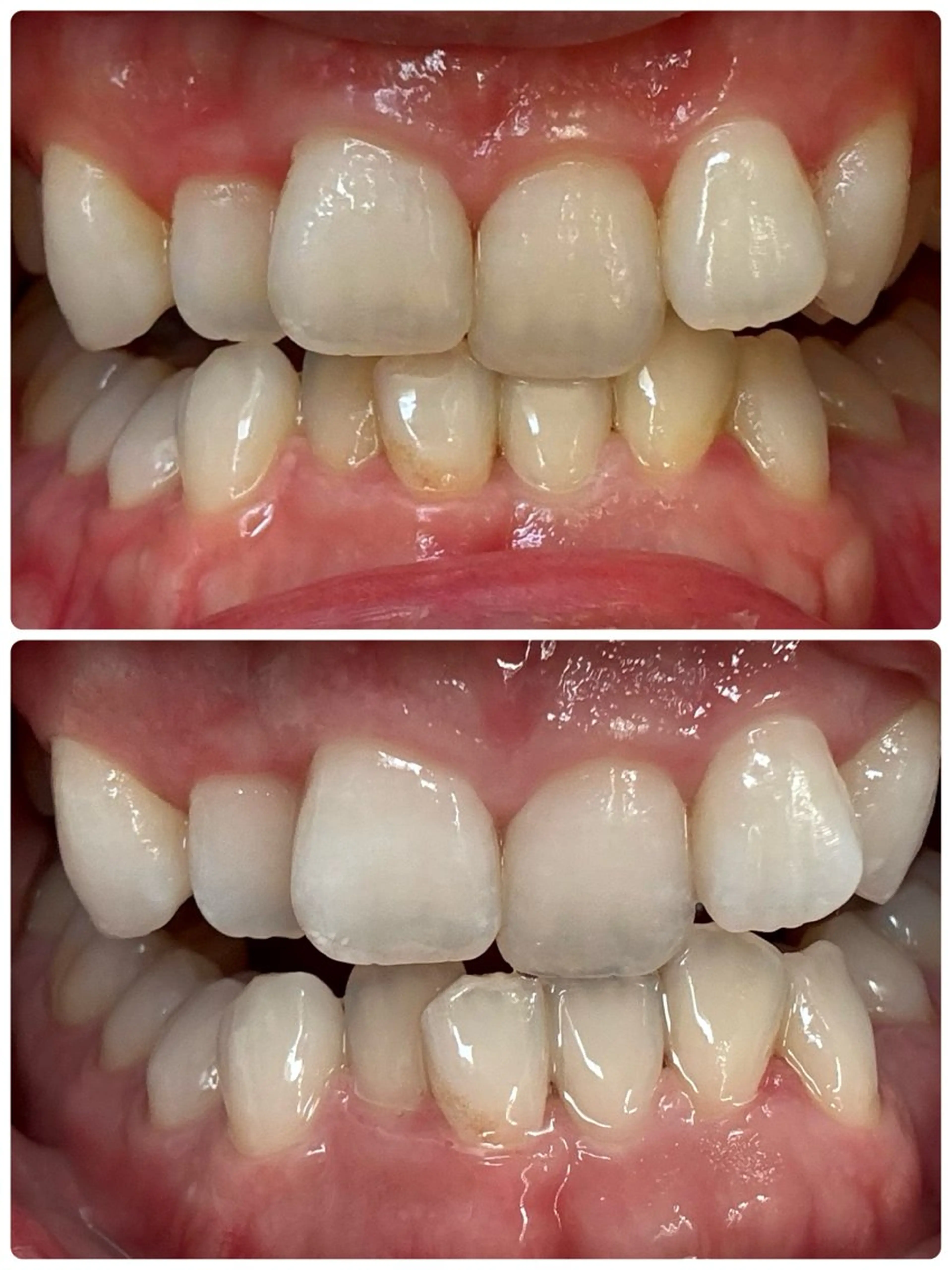 セルフホワイトニングの写真